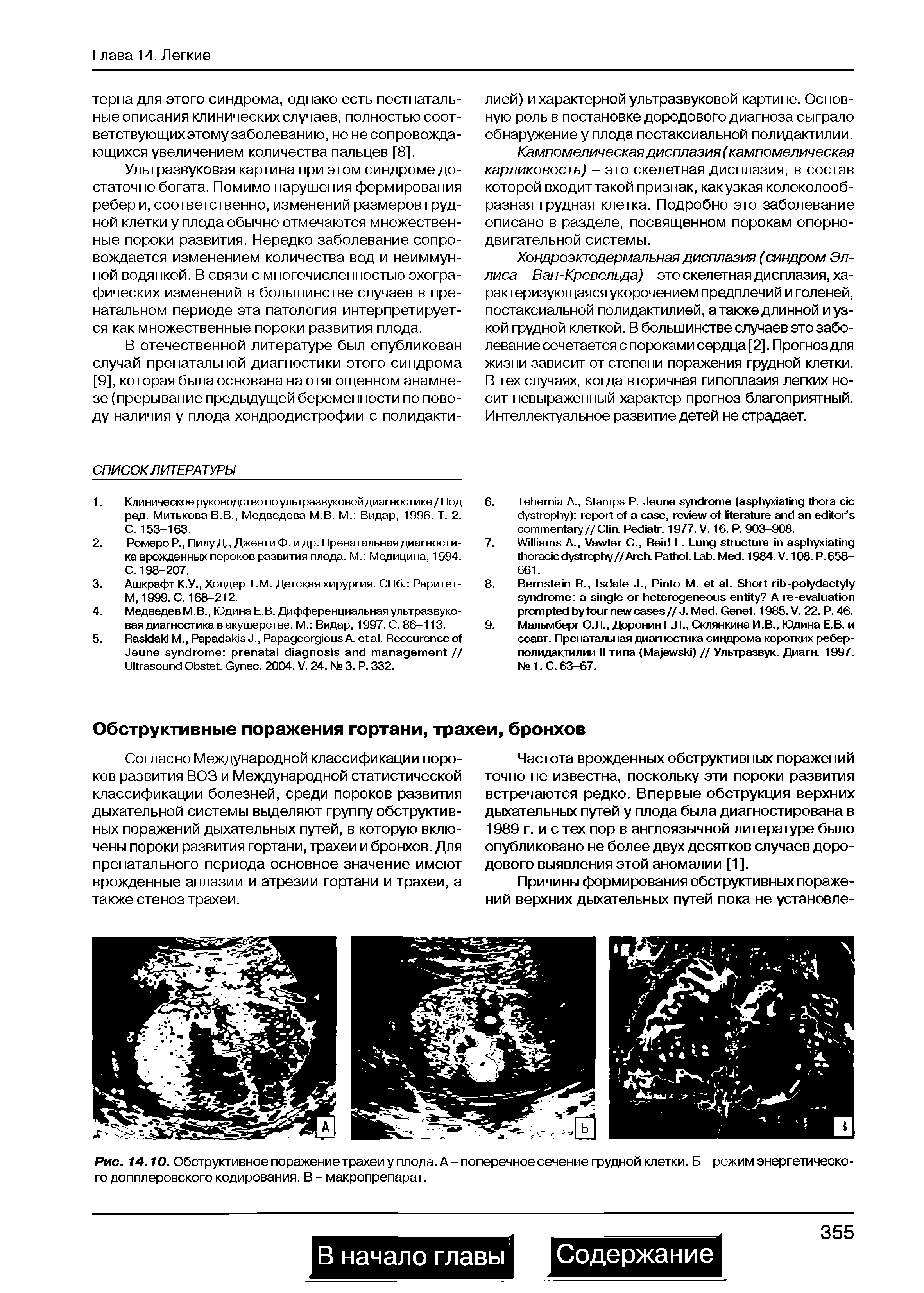 Рис. 14.10. Обструктивное поражение трахеи у плода. А - поперечное сечение грудной клетки. Б - режим энергетического допплеровского кодирования. В - макропрепарат.