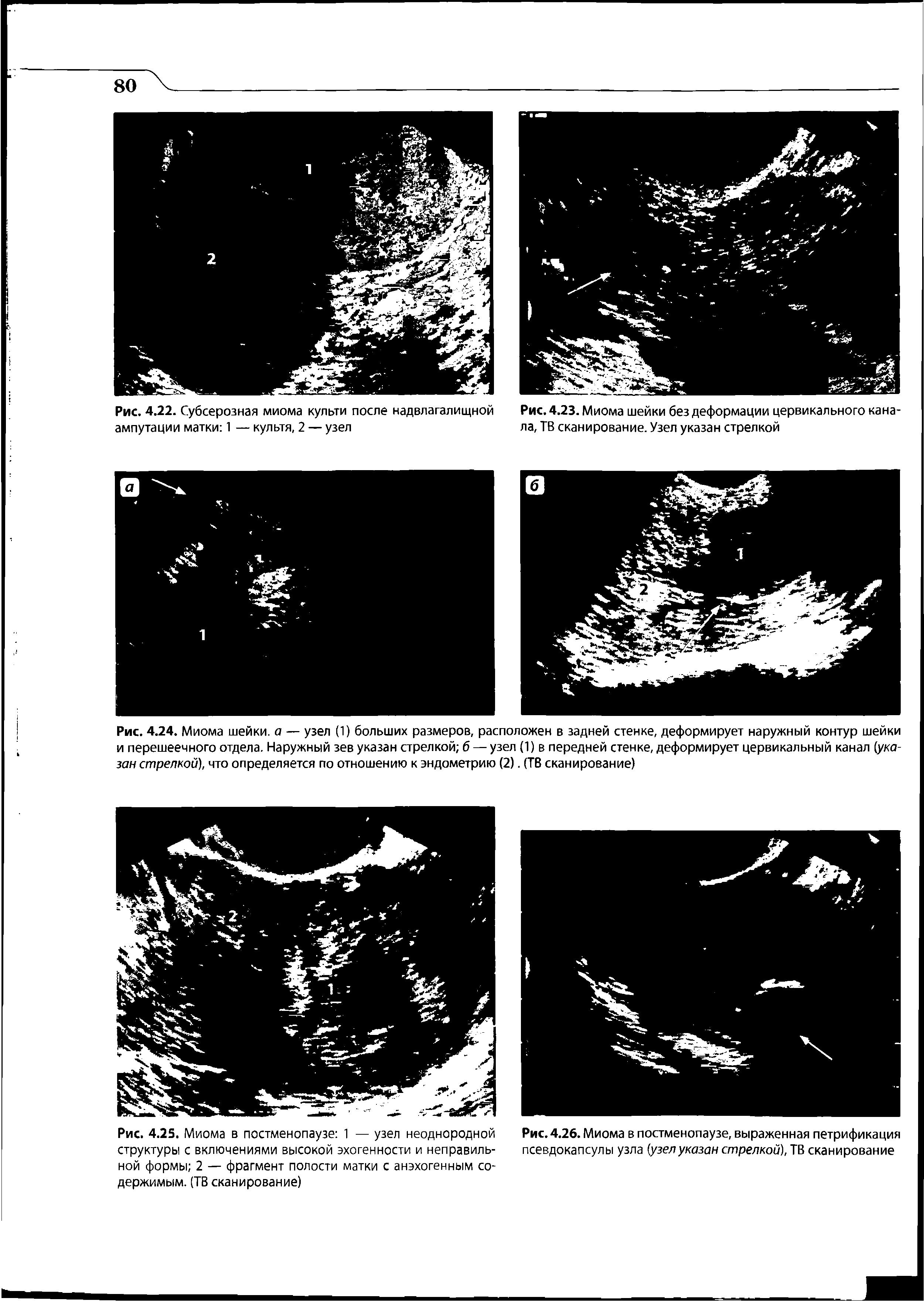 Рис. 4.25. Миома в постменопаузе 1 — узел неоднородной Рис. 4.26. Миома в постменопаузе, выраженная петрификация структуры с включениями высокой эхогенности и неправиль- псевдокапсулы узла (узелуказан стрелкой), ТВ сканирование ной формы 2 — фрагмент полости матки с анэхогенным со-...