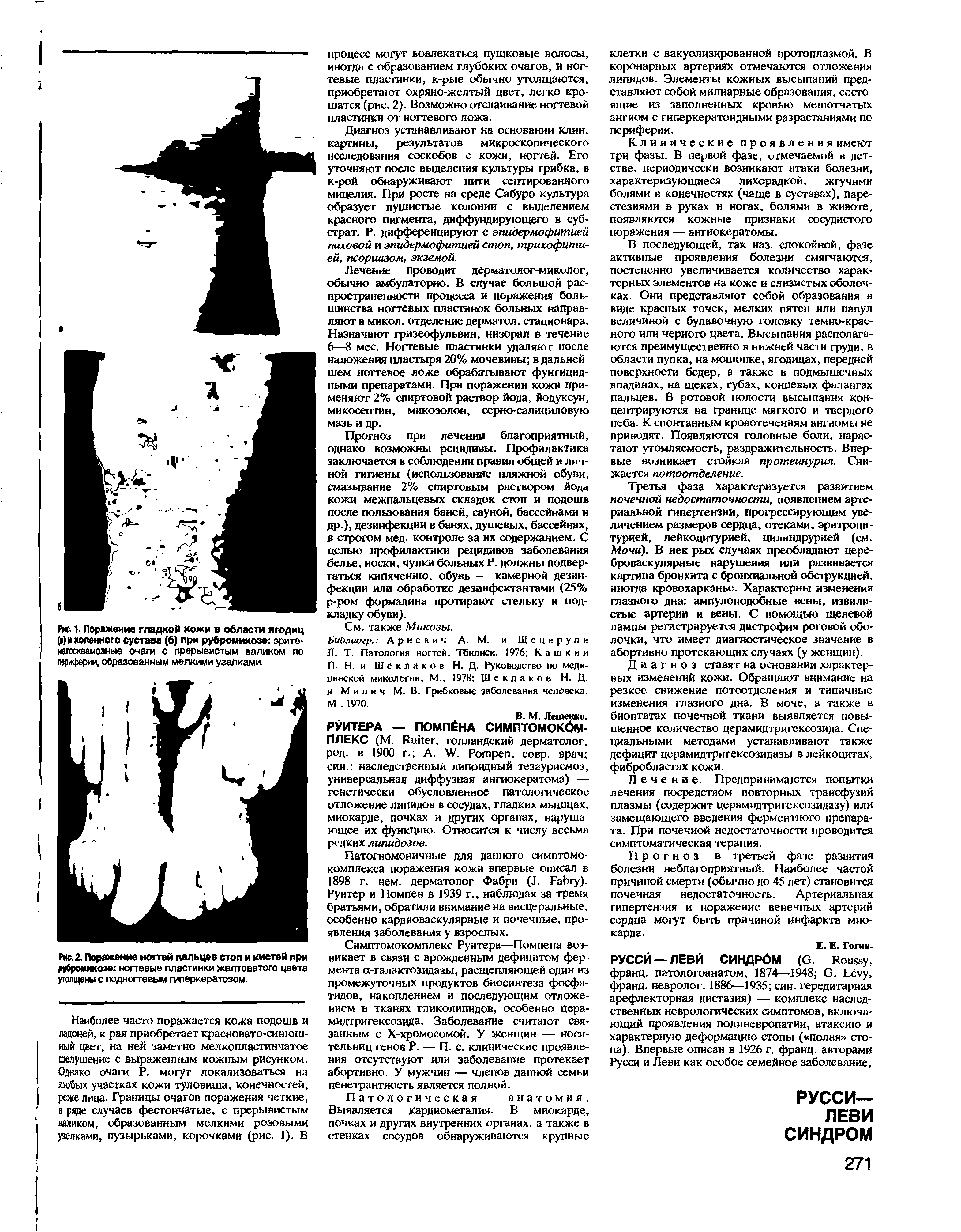 Рис. 2. Поражение ногтей пальцев стоп и кистей при рубромикозе ногтевые пластинки желтоватого цвета утолщены с подногтевым гиперкератозом.