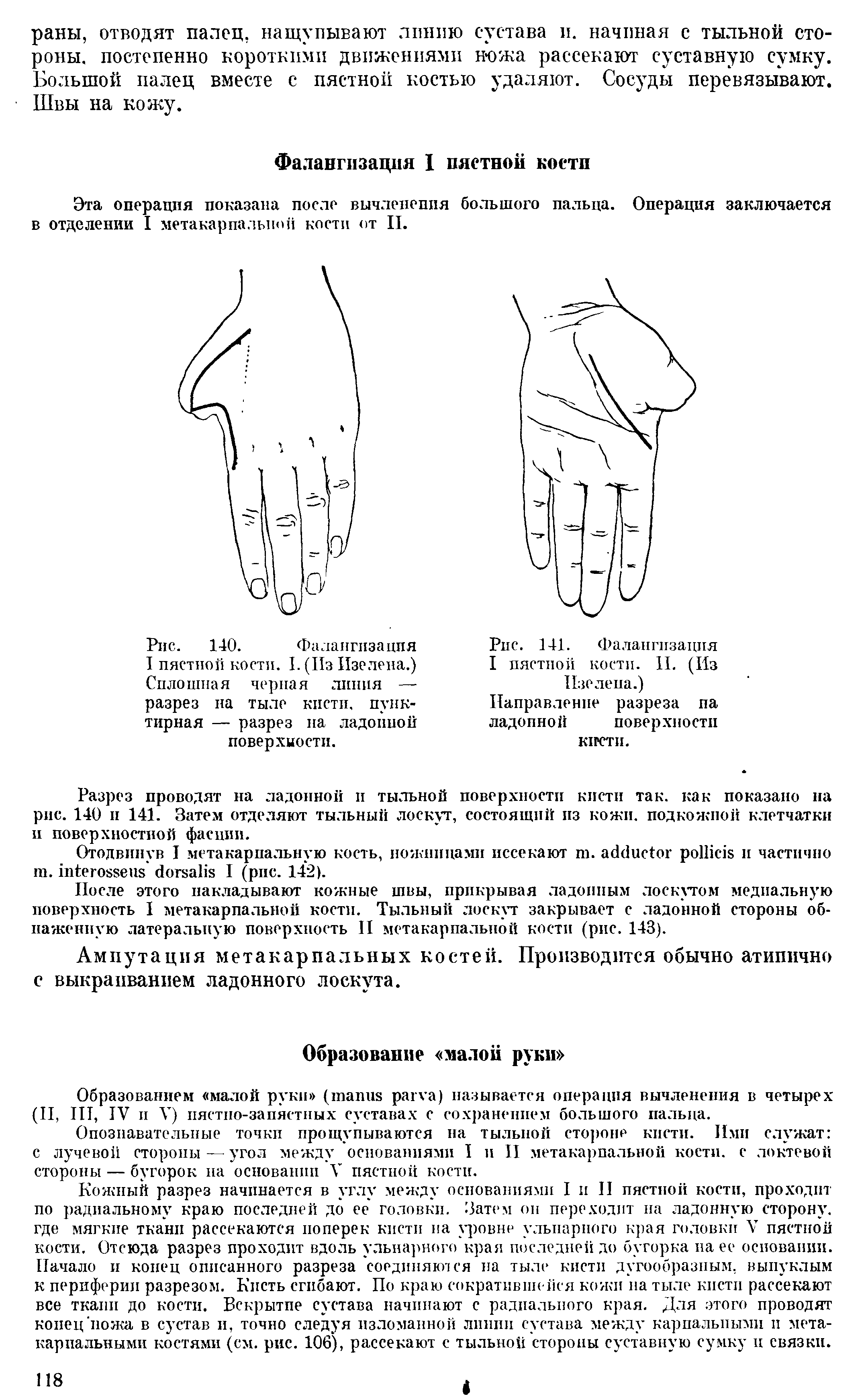 Рис. 140. Фалангизацпя I пястной кости. I. (Из Изе лена.) Сплошная черная линия — разрез на тыле кисти, пунктирная — разрез на ладонной поверхности.