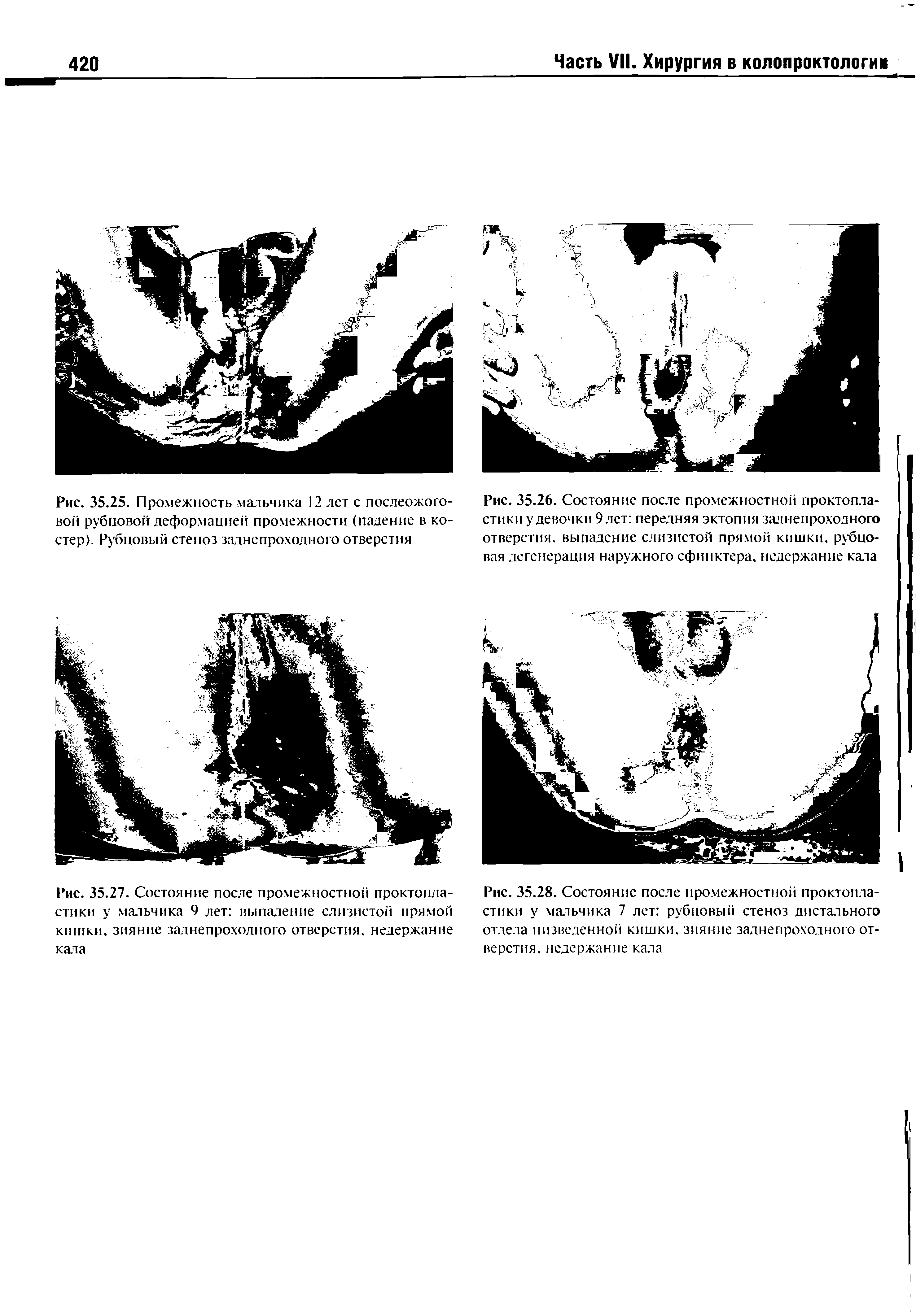 Рис. 35.26. Состояние после промежностной проктопла-стики у девочки 9лст передняя эктопия заднепроходного отверстия, выпадение слизистой прямой кишки, рубцовая дегенерация наружного сфинктера, недержание кала...