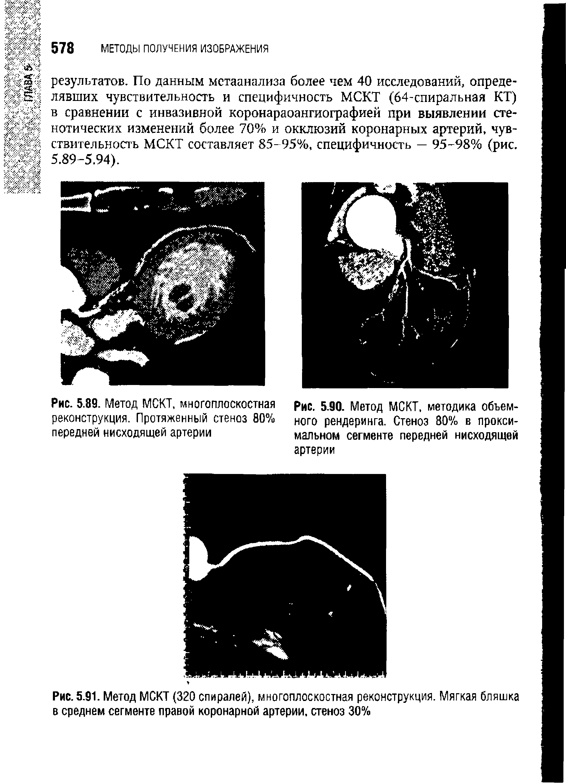 Рис. 5.91. Метод МСКТ (320 спиралей), многоплоскостная реконструкция. Мягкая бляшка в среднем сегменте правой коронарной артерии, стеноз 30%...