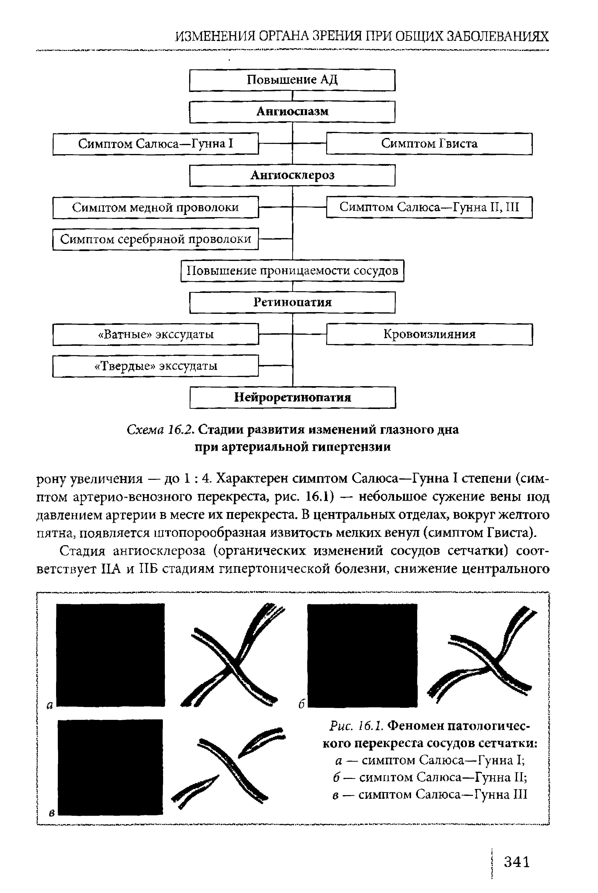 Рис. 16.1. Феномен патологичес- кого перекреста сосудов сетчатки а — симптом Салюса—Гунна I ...