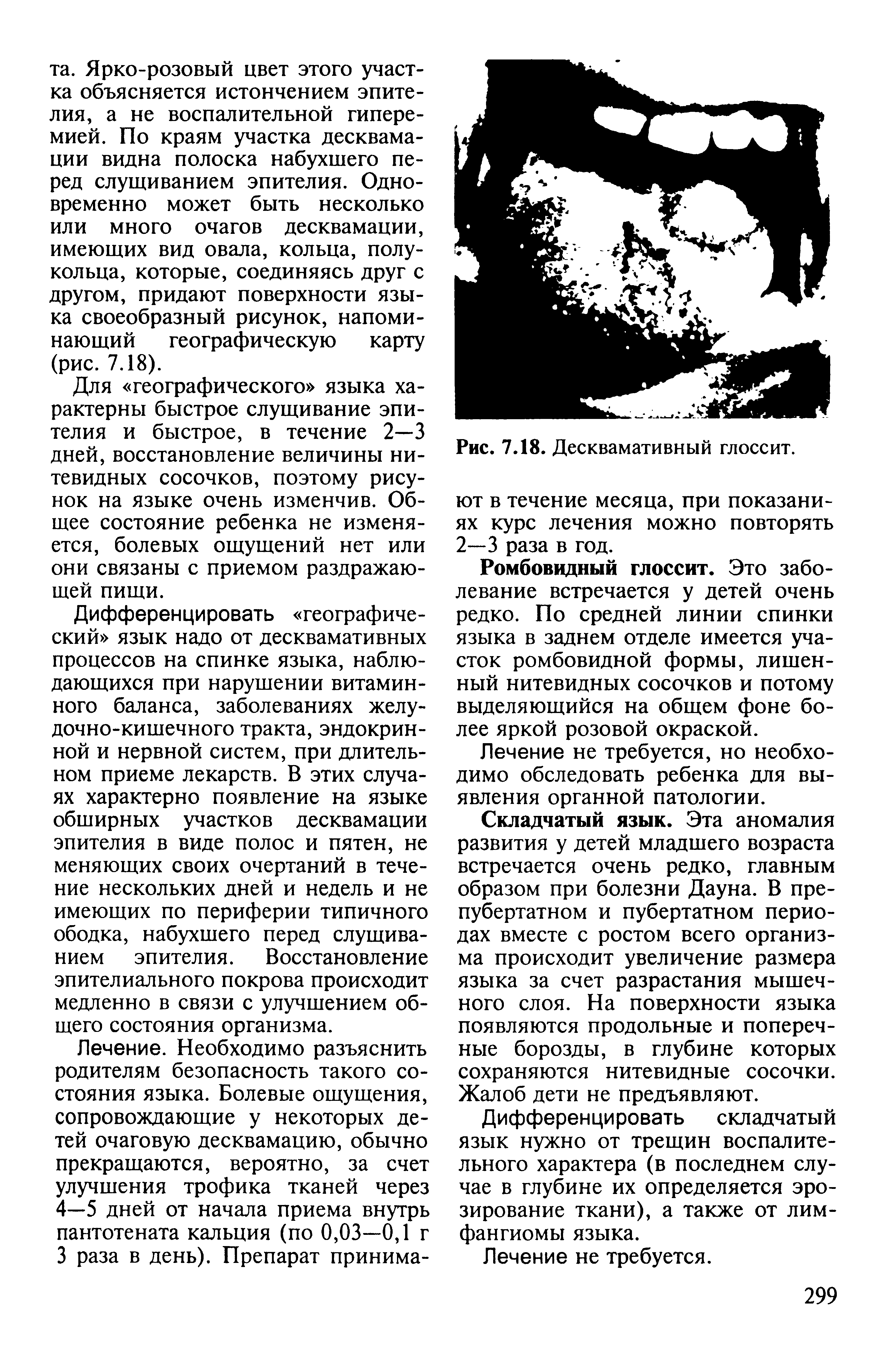 Рис. 7.18. Десквамативный глоссит, ют в течение месяца, при показаниях курс лечения можно повторять 2—3 раза в год.