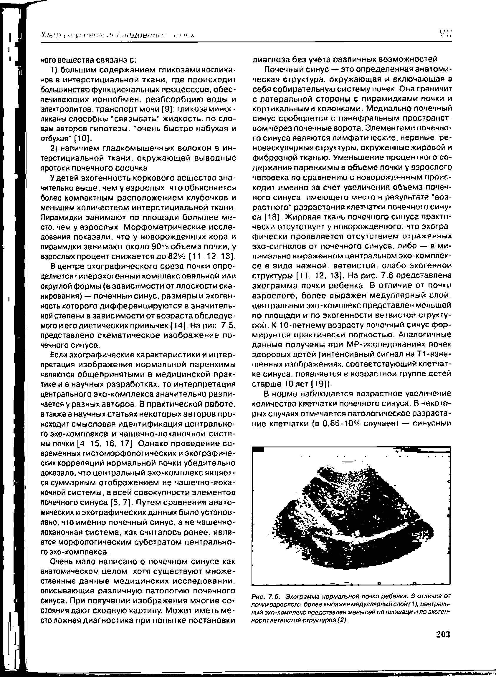 Рис. 7.6. Эхограмма нормальной почки ребенка. В ыличхо от почкиззрсслргО более нырахйн мйдулларнымслой( ). центральный оха-кпмплокр представлен меньшей по шюшади и по анаген-нести яетвщтшйсгрукгурай (2).