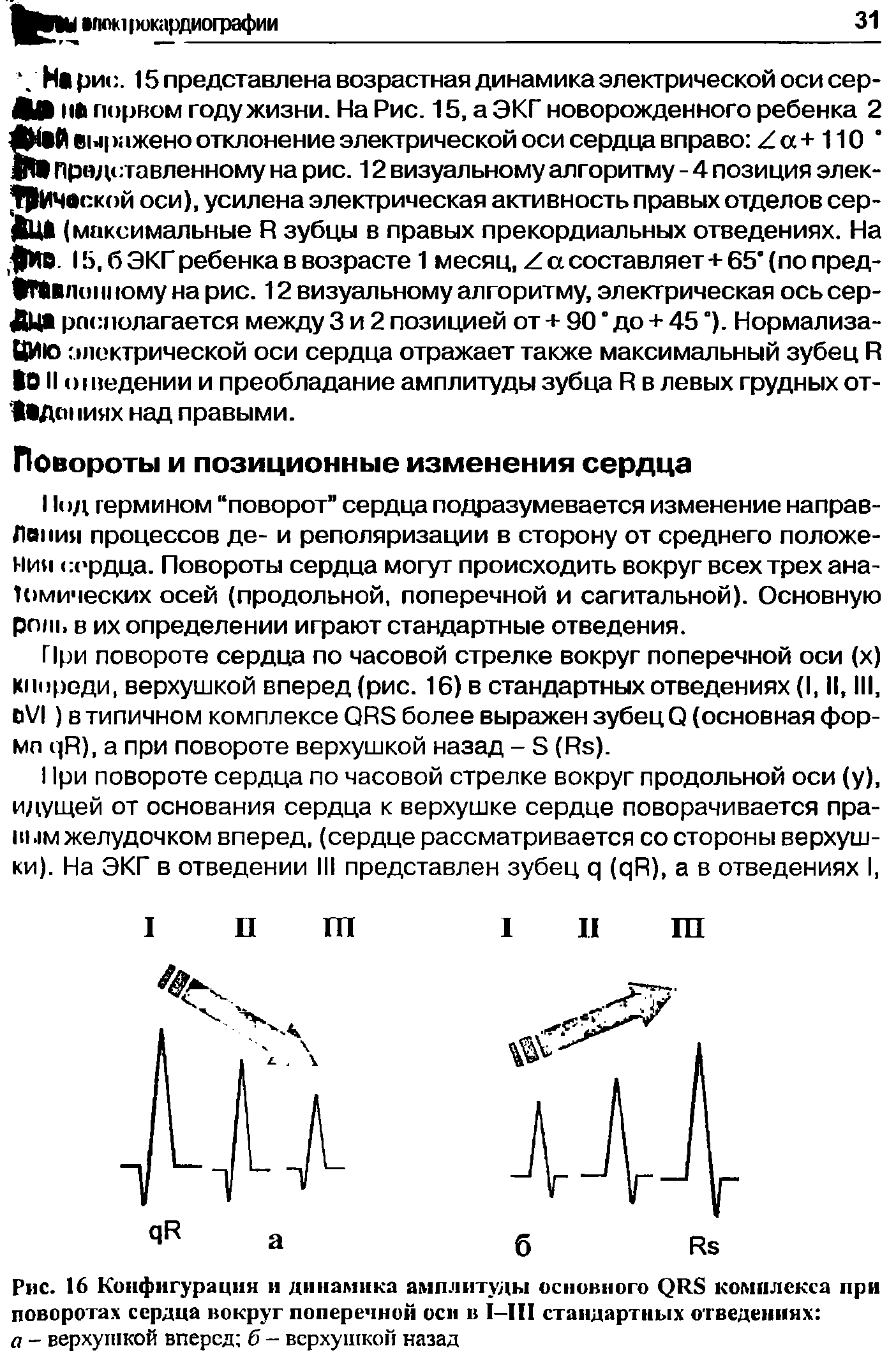 Рис. 16 Конфигурация и динамика амплитуды основного QRS комплекса при поворотах сердца вокруг поперечной оси в I—III стандартных отведениях а - верхушкой вперед б - верхушкой назад...