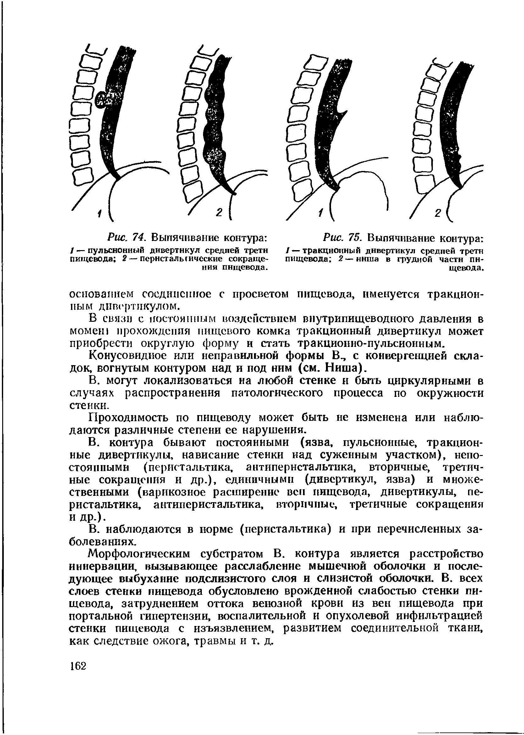 Рис. 75. Выпячивание контура / — тракционный дивертикул средней трети пищевода 2 — ниша в грудной части пищевода.