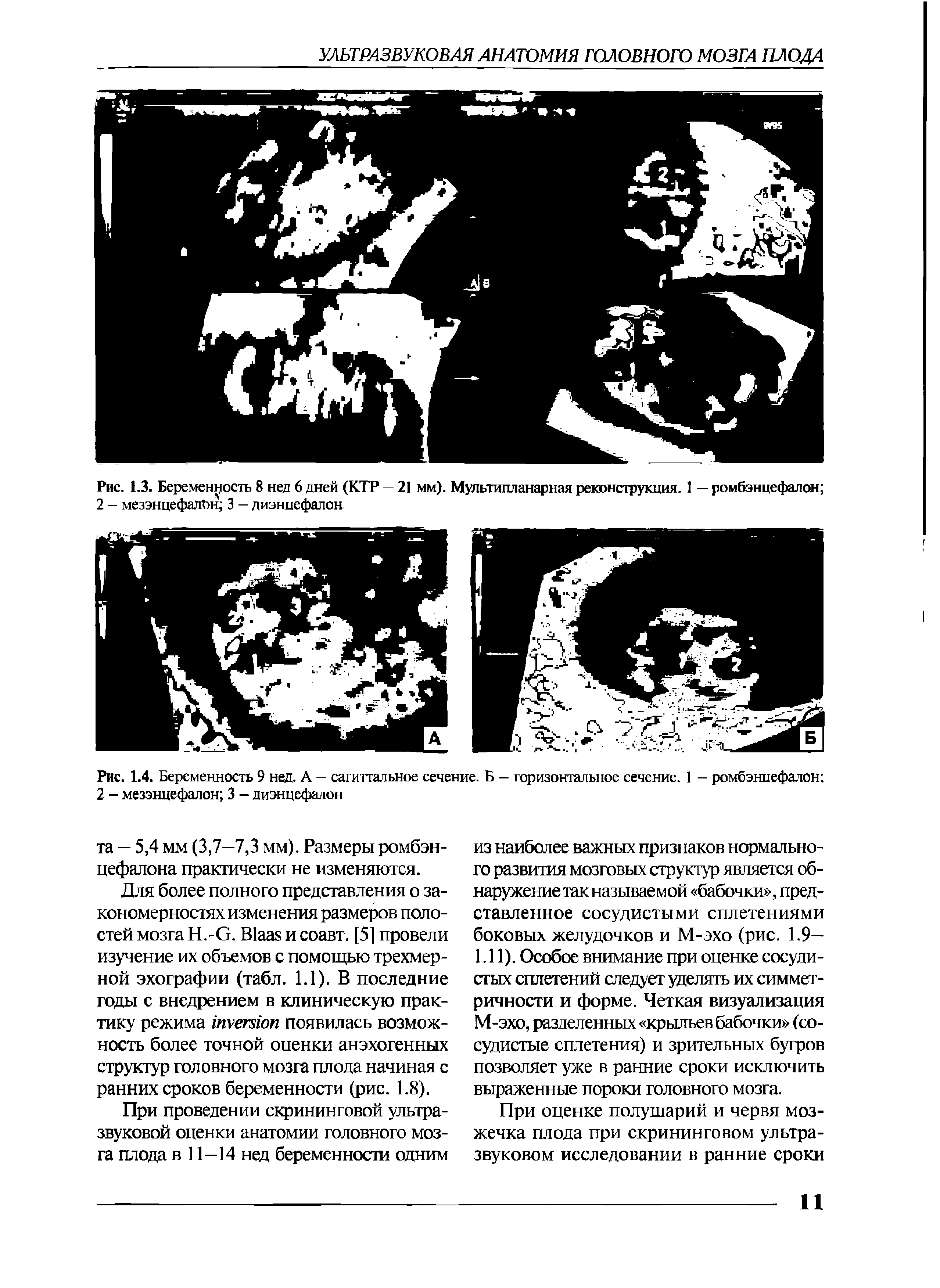 Рис. 1.4. Беременность 9 нед. А — сагиттальное сечение. Б - горизонтальное сечение. 1 — ромбэнцефалон 2 - мезэнцефалон 3 — диэнцефалон...