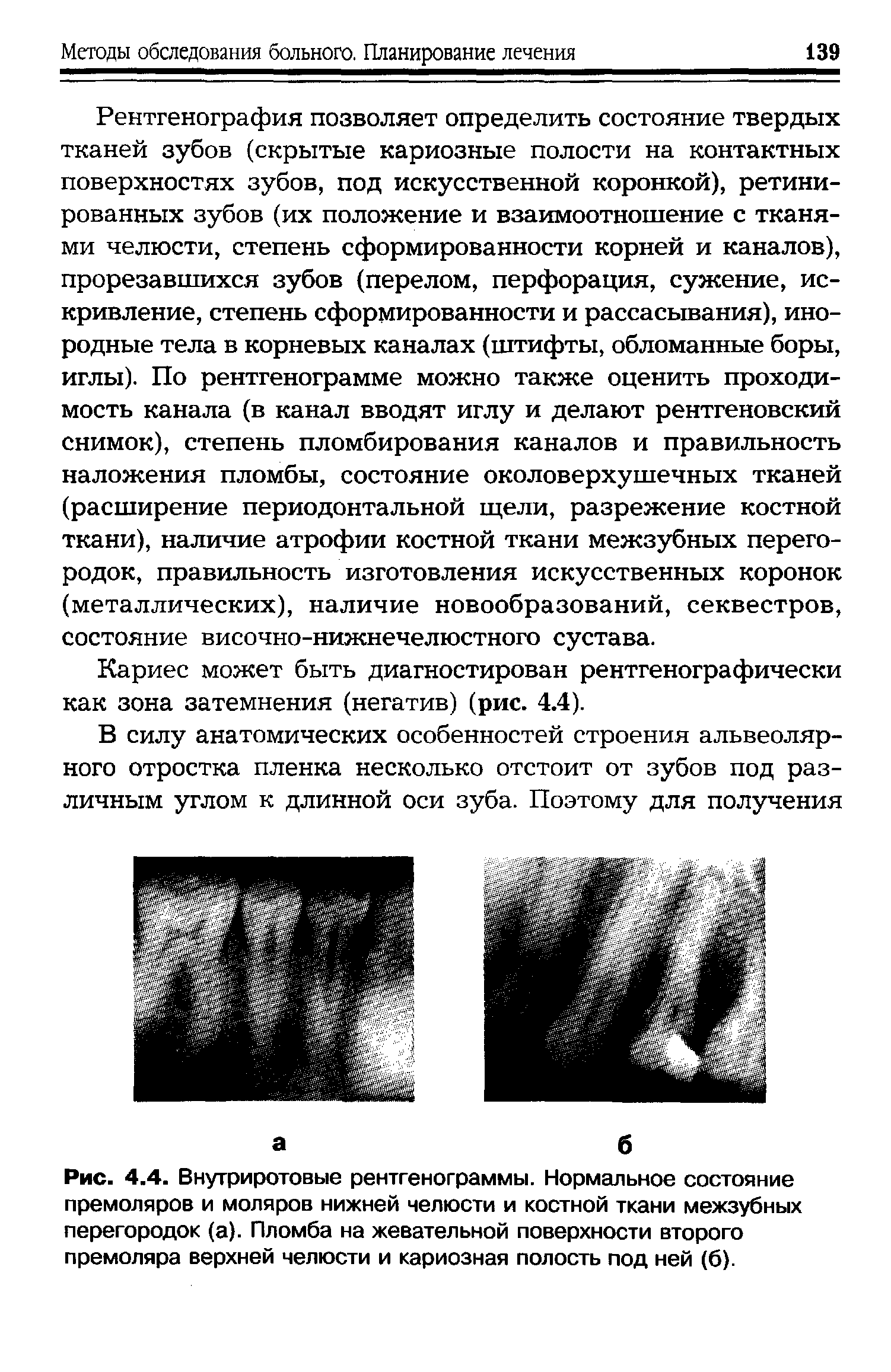 Рис. 4.4. Внутриротовые рентгенограммы. Нормальное состояние премоляров и моляров нижней челюсти и костной ткани межзубных перегородок (а). Пломба на жевательной поверхности второго премоляра верхней челюсти и кариозная полость под ней (6).