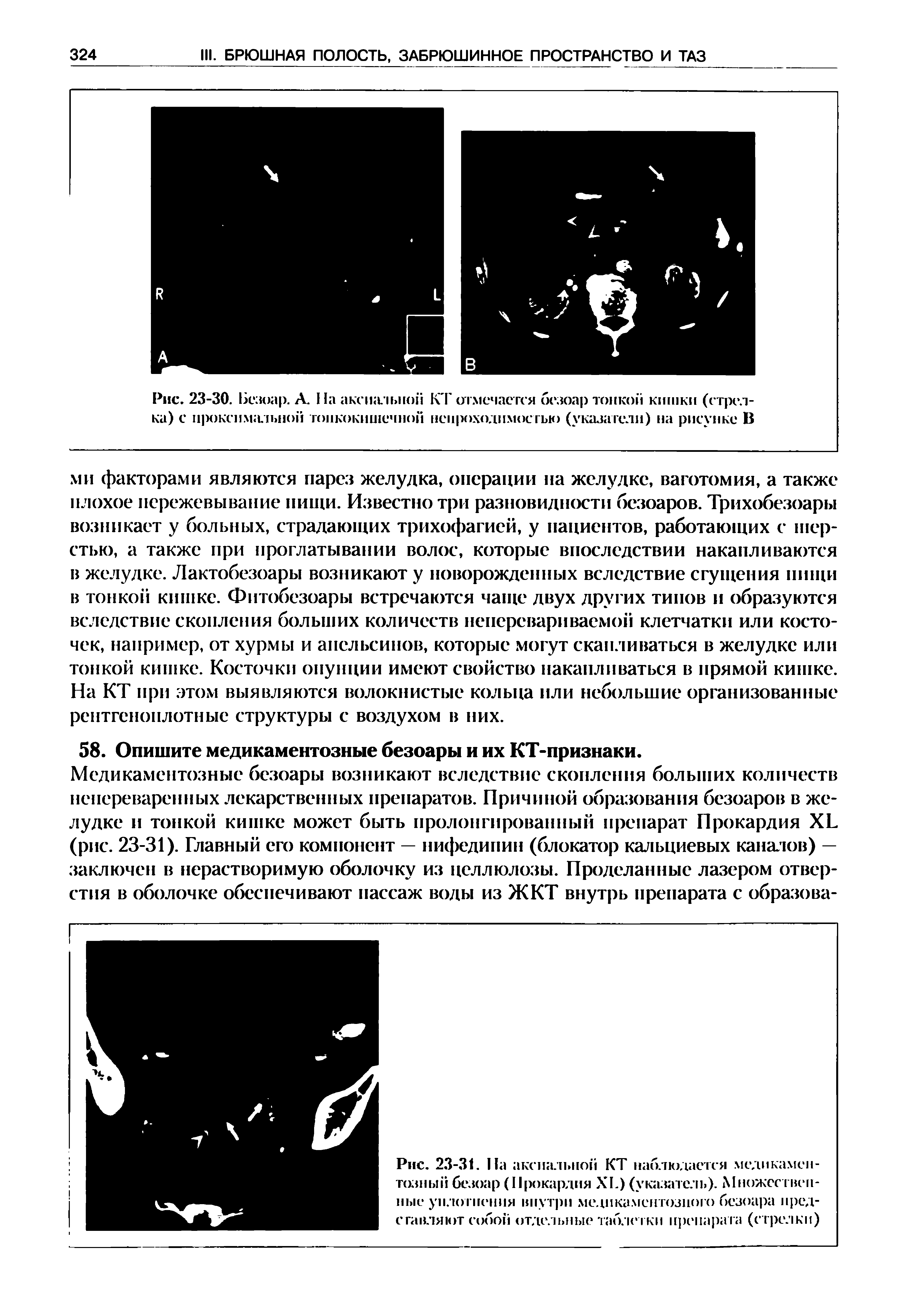 Рис. 23-31. На аксиальной КТ наблюдается медикаментозный безоар (Прокардия XI.) (указатель). Множественные уплотнения внутри медикаментозного безоара представляют собой отдельные таблетки препарата (стрелки)...