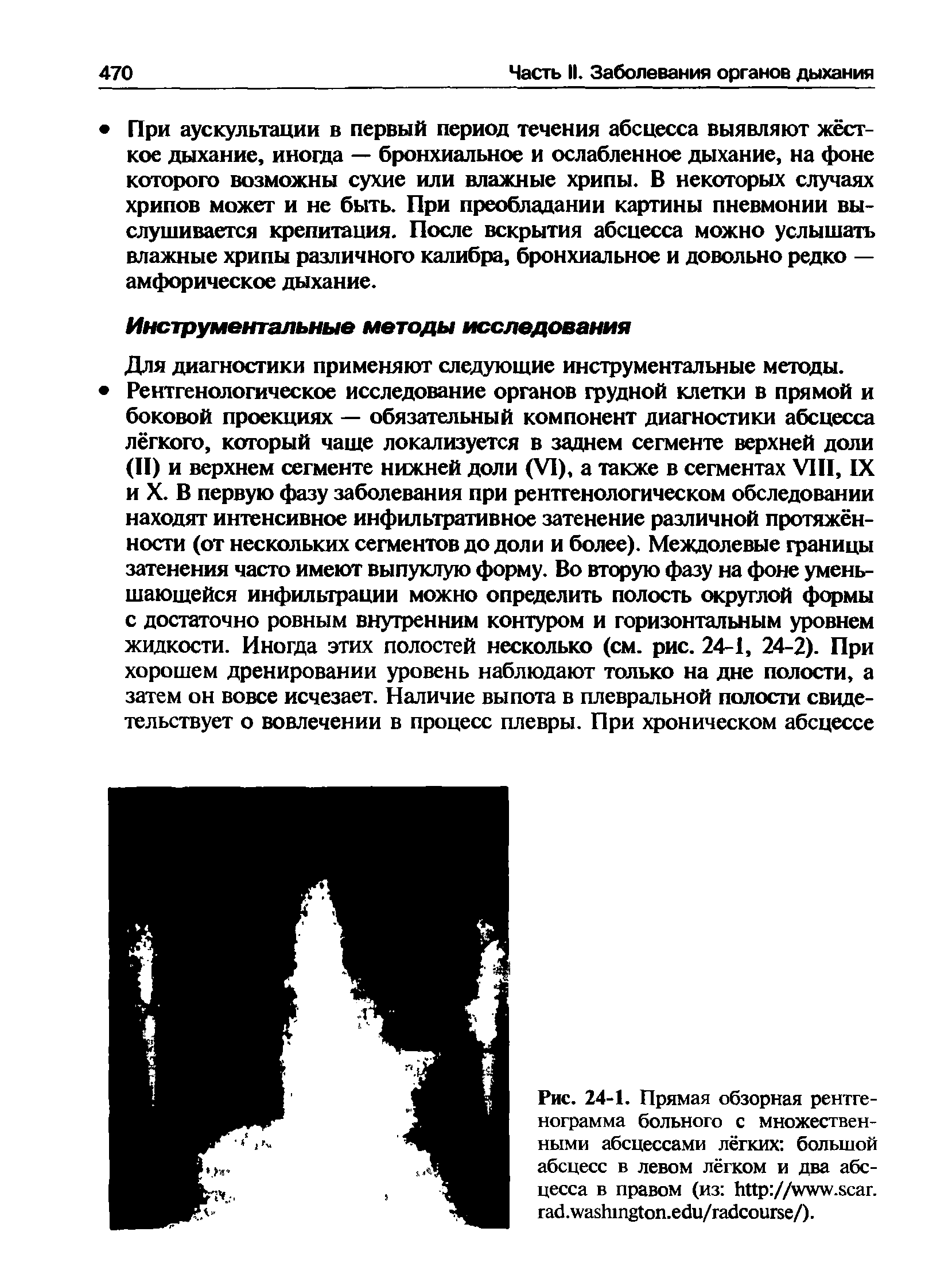 Рис. 24-1. Прямая обзорная рентгенограмма больного с множественными абсцессами лёгких большой абсцесс в левом лёгком и два абсцесса в правом (из // . . . . / /).