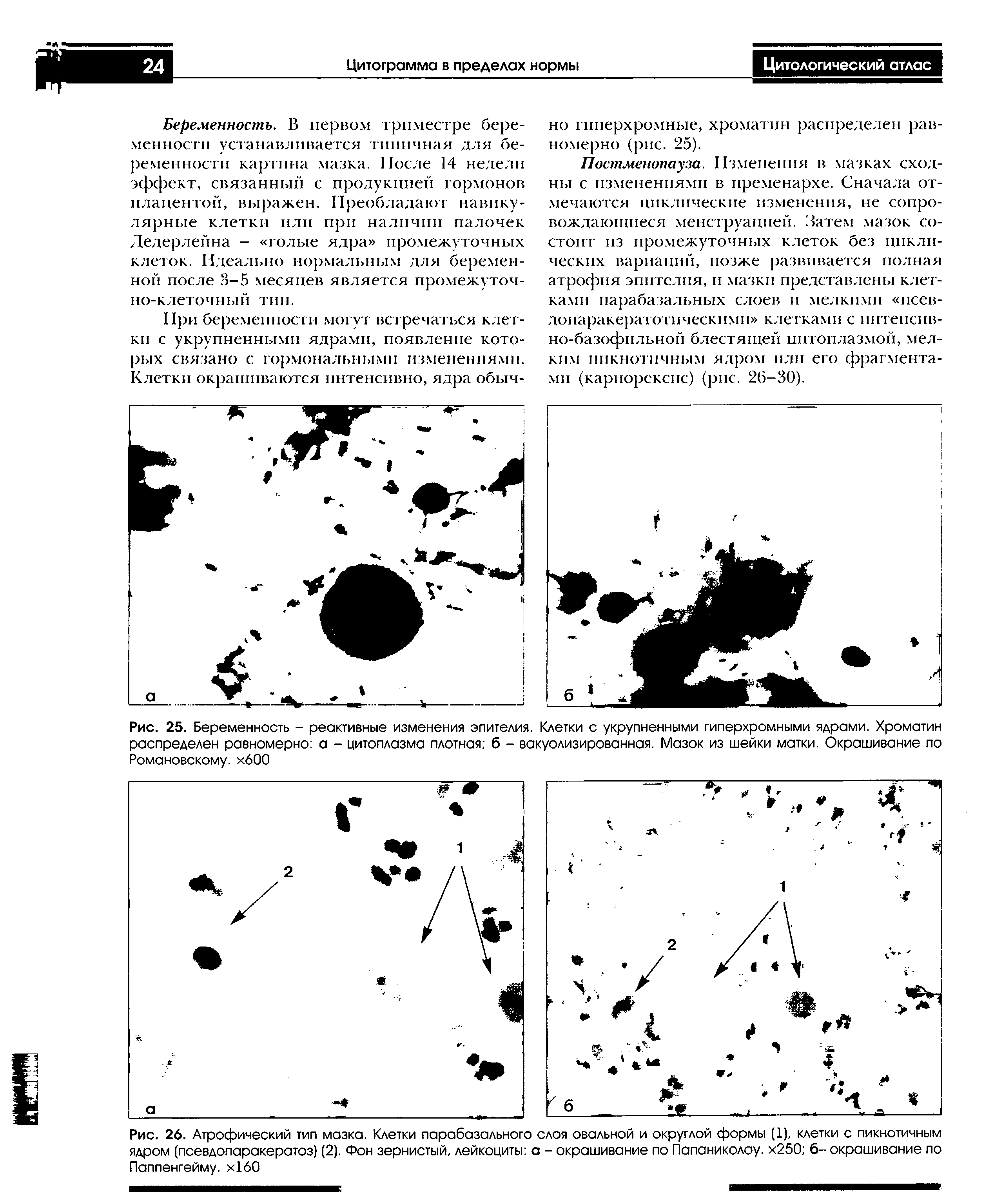 Рис. 25. Беременность - реактивные изменения эпителия. Клетки с укрупненными гиперхромными ядрами. Хроматин распределен равномерно а - цитоплазма плотная б - вакуолизированная. Мазок из шейки матки. Окрашивание по Романовскому. хбОО...