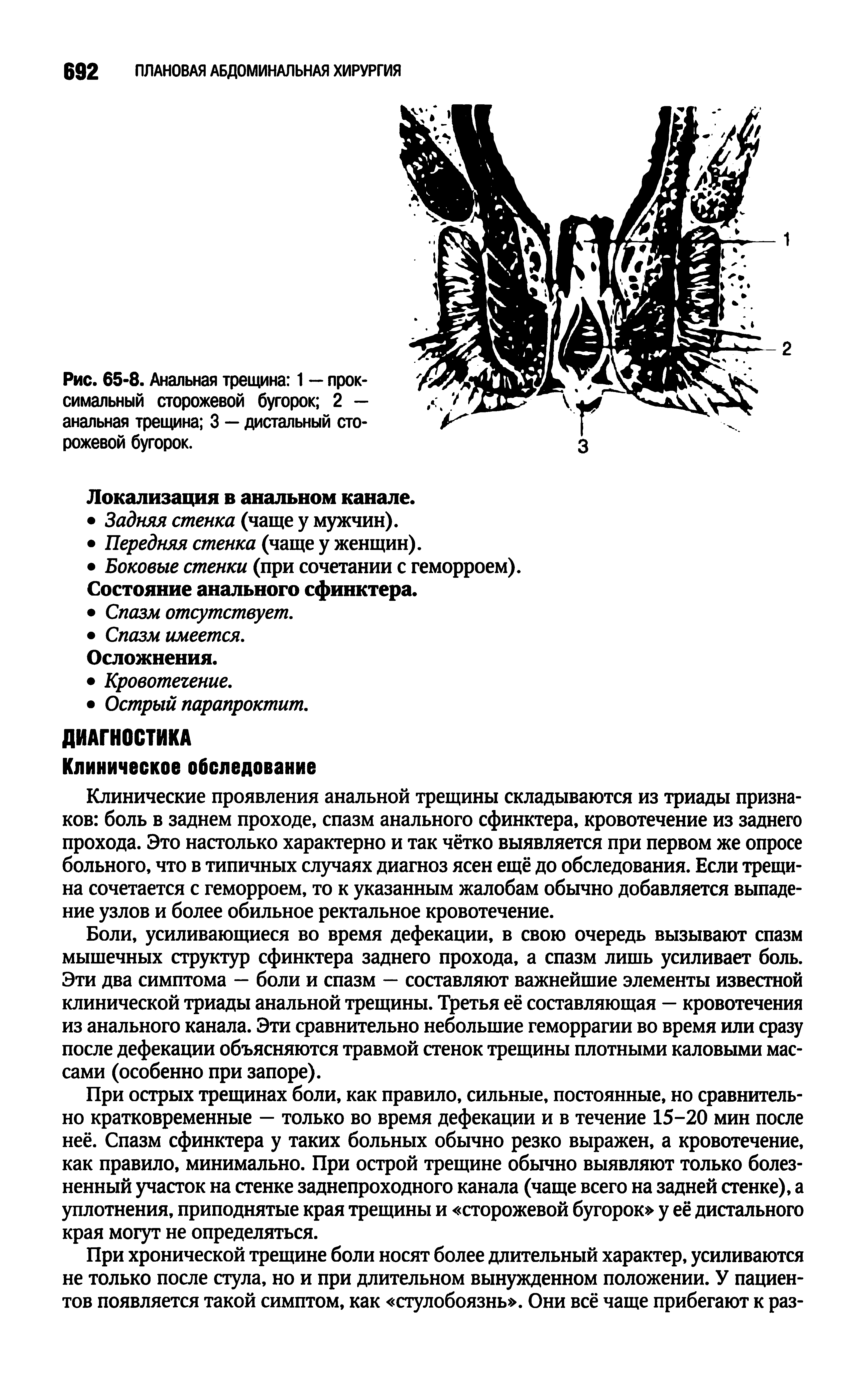 Рис. 65-8. Анальная трещина 1 — прок симальный сторожевой бугорок 2 — анальная трещина 3 — дистальный сторожевой бугорок.