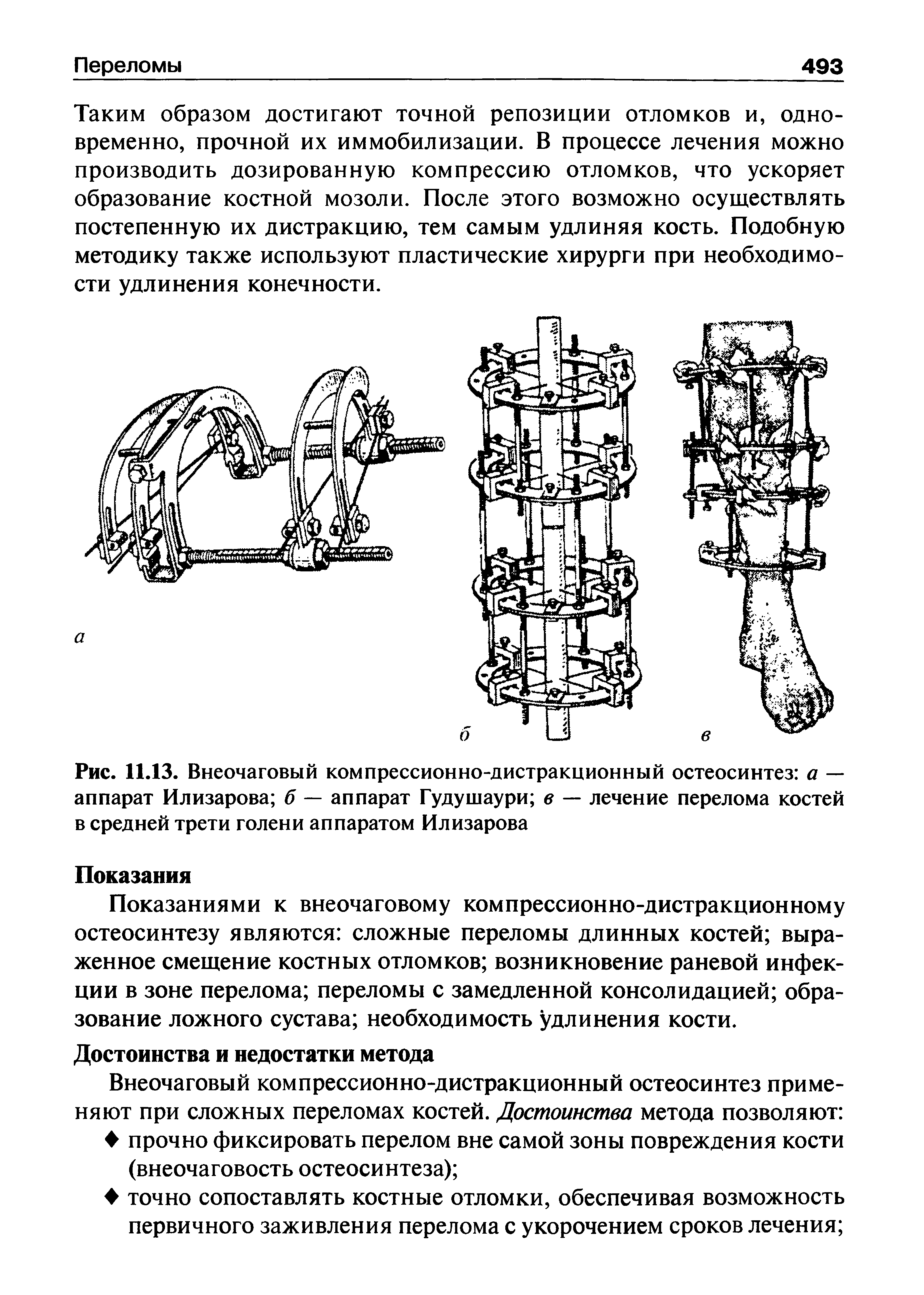 Рис. 11.13. Внеочаговый компрессионно-дистракционный остеосинтез а — аппарат Илизарова б — аппарат Гудушаури в — лечение перелома костей в средней трети голени аппаратом Илизарова...