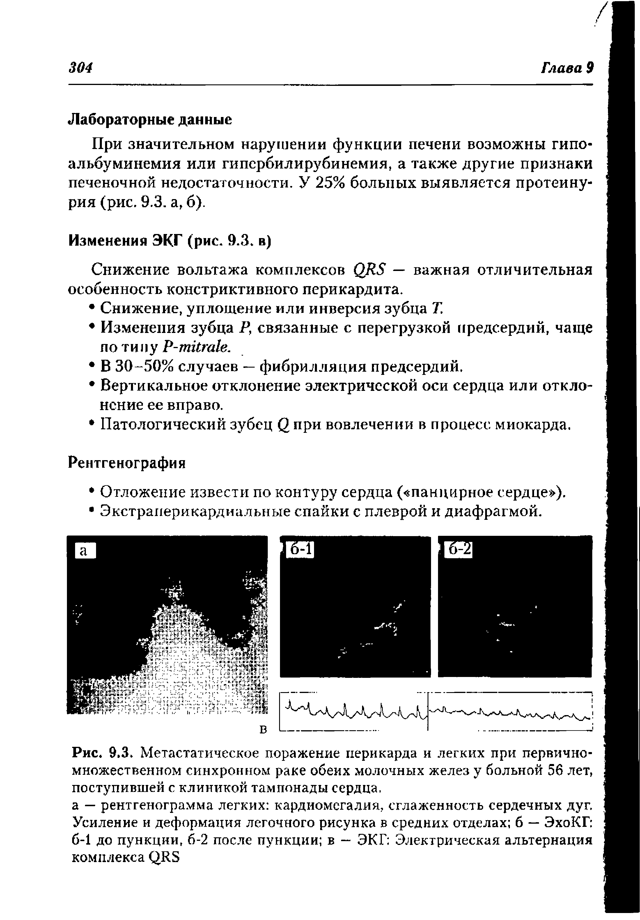 Рис. 9.3. Метастатическое поражение перикарда и легких при первичномножественном синхронном раке обеих молочных желез у больной 56 лет, поступившей с клиникой тампонады сердца.