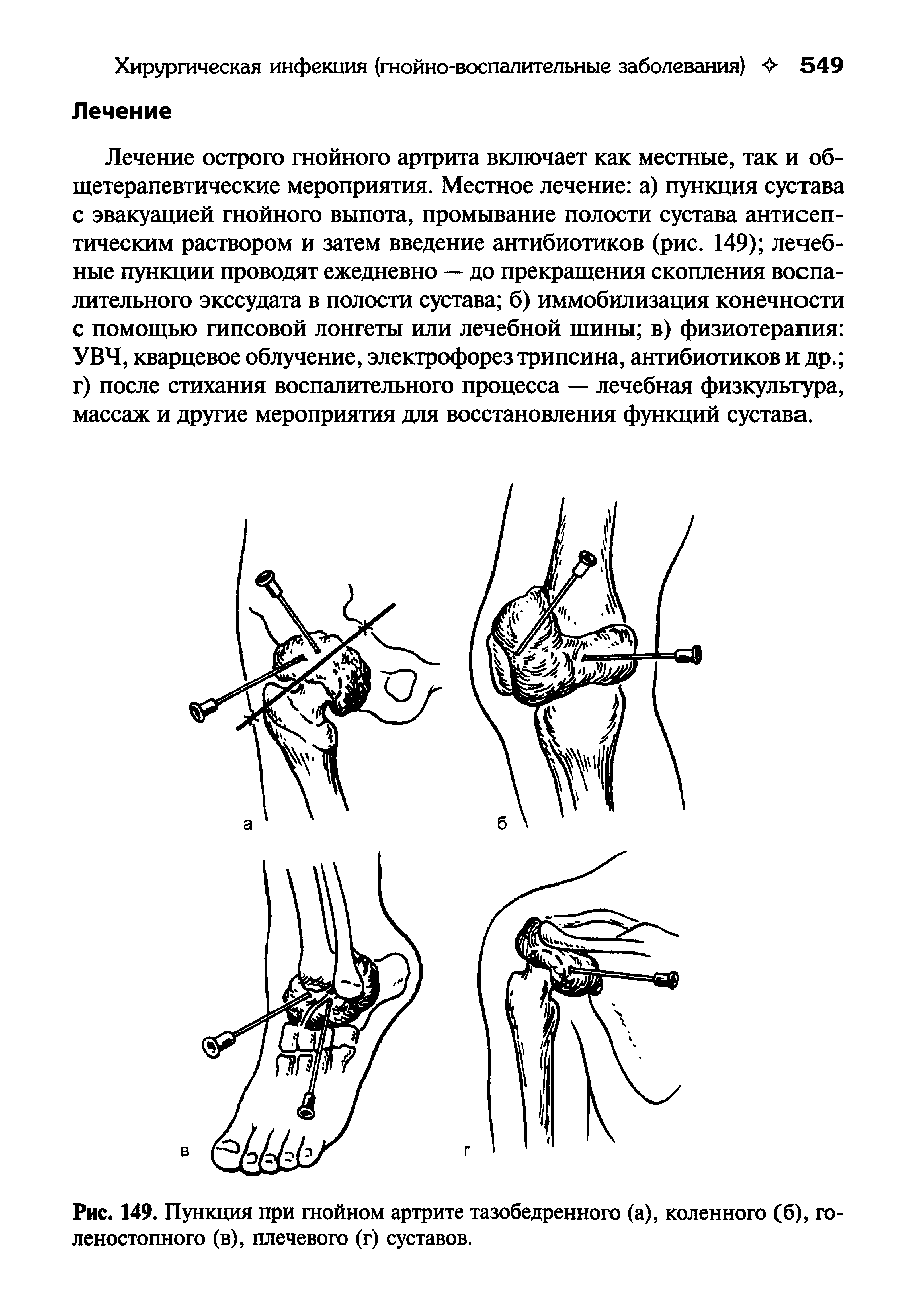 Рис. 149. Пункция при гнойном артрите тазобедренного (а), коленного (б), голеностопного (в), плечевого (г) суставов.