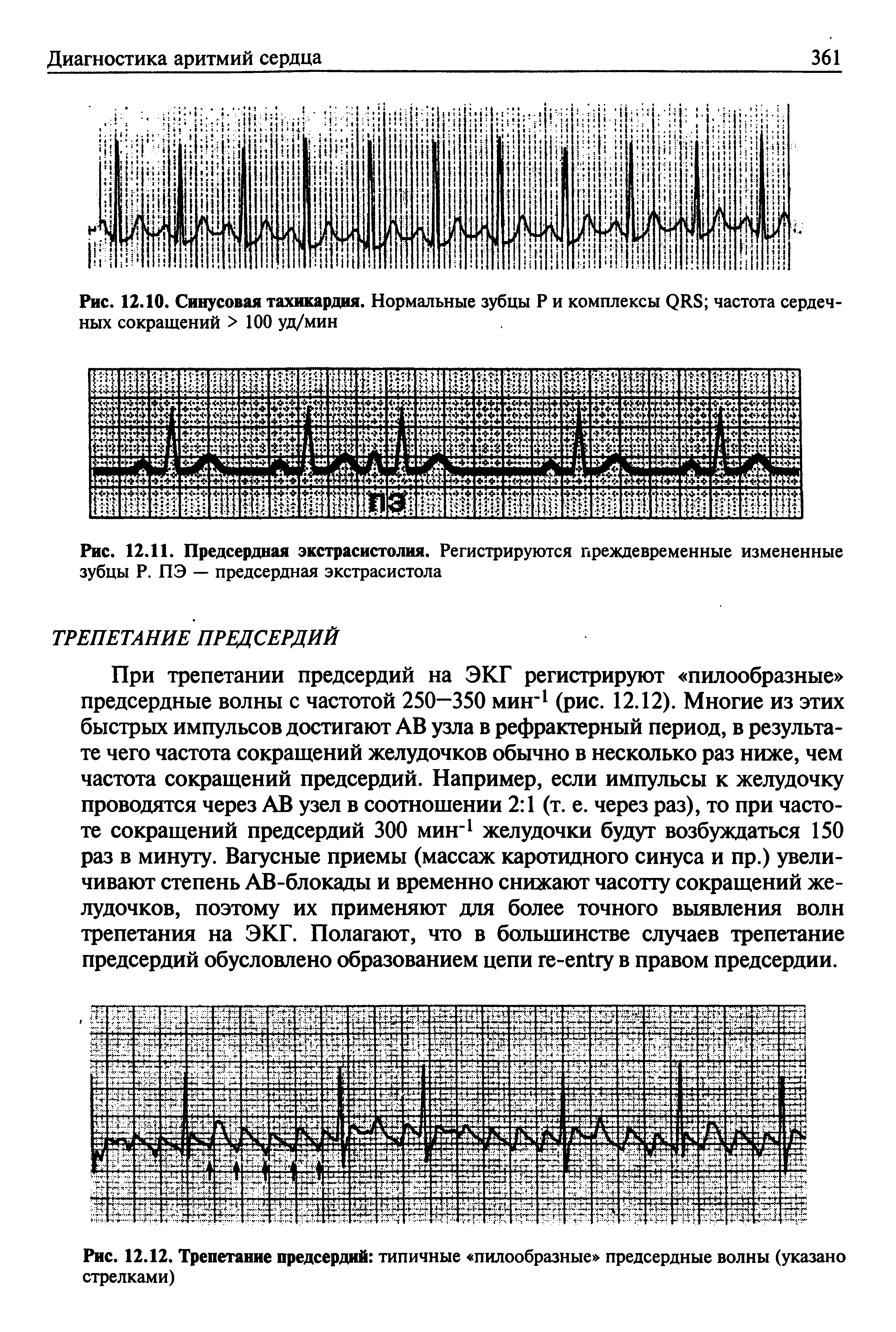 Рис. 12.12. Трепетание предсердий типичные пилообразные предсердные волны (указано стрелками)...