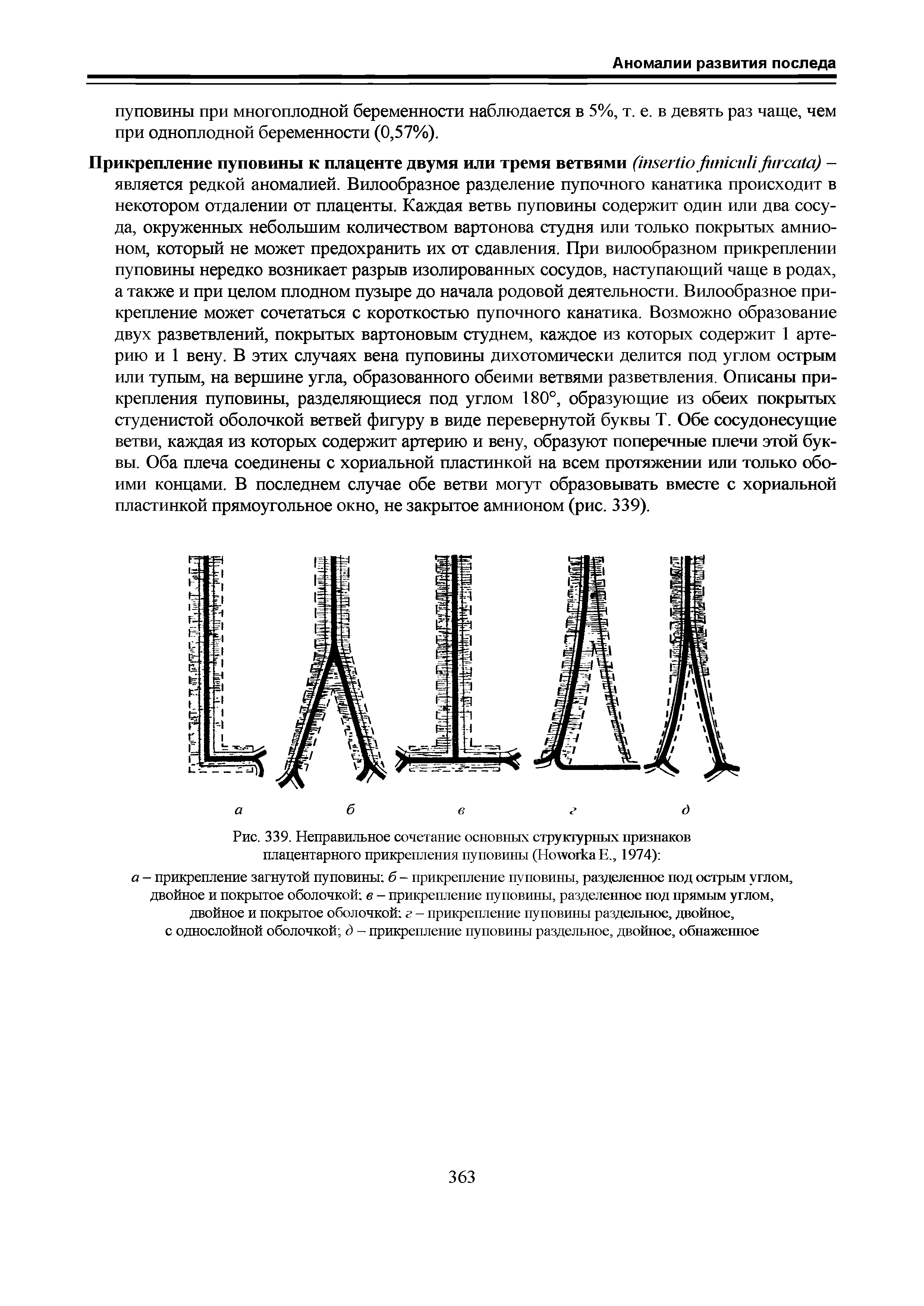 Рис. 339. Неправильное сочетание основных структурных признаков плацентарного прикрепления пуповины (НолтогкаЕ., 1974) ...