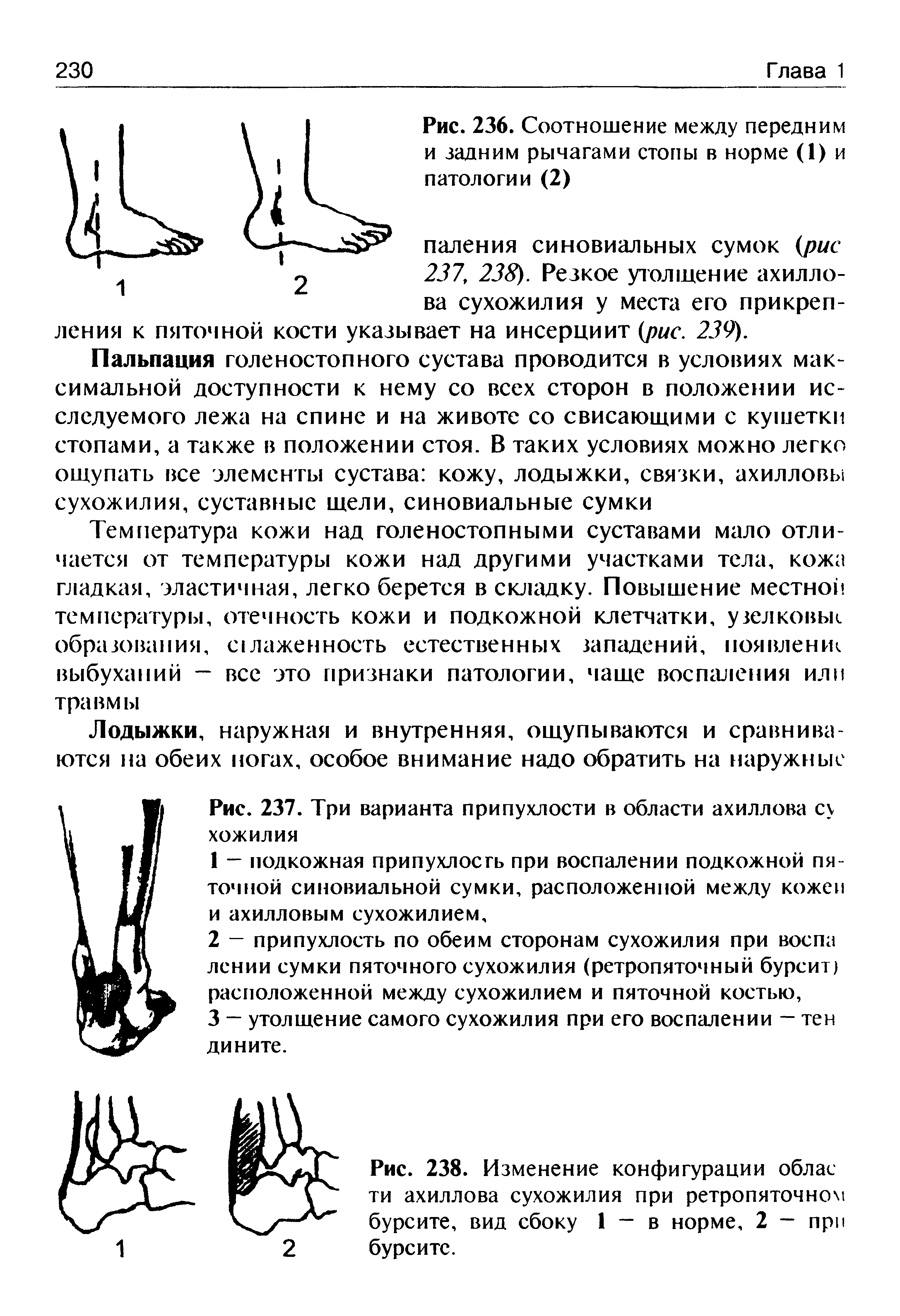 Рис. 238. Изменение конфигурации облас ти ахиллова сухожилия при ретропяточном бурсите, вид сбоку 1 - в норме, 2 - при бурсите.