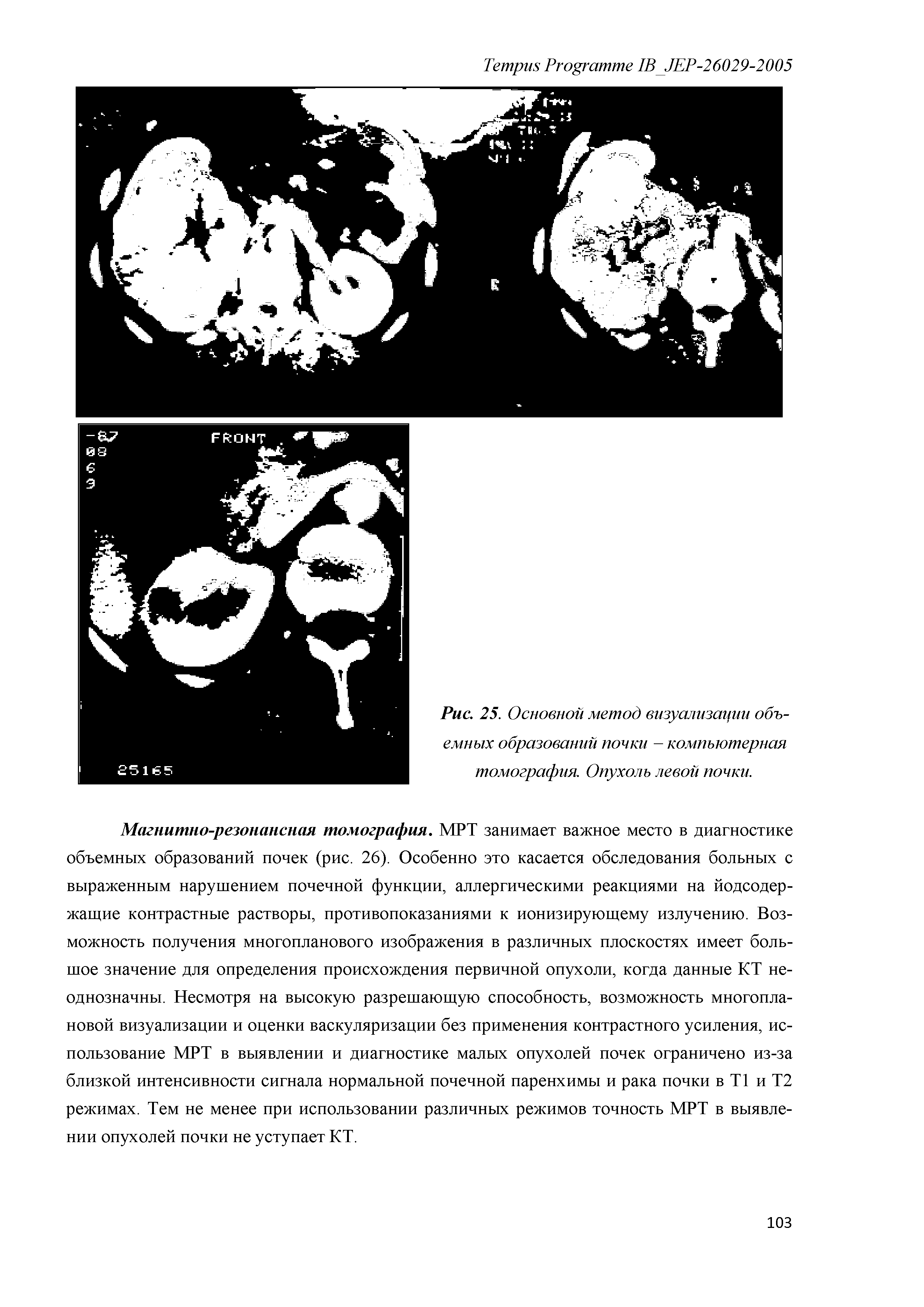 Рис. 25. Основной метод визуализации объемных образований почки - компьютерная томография. Опухоль левой почки.