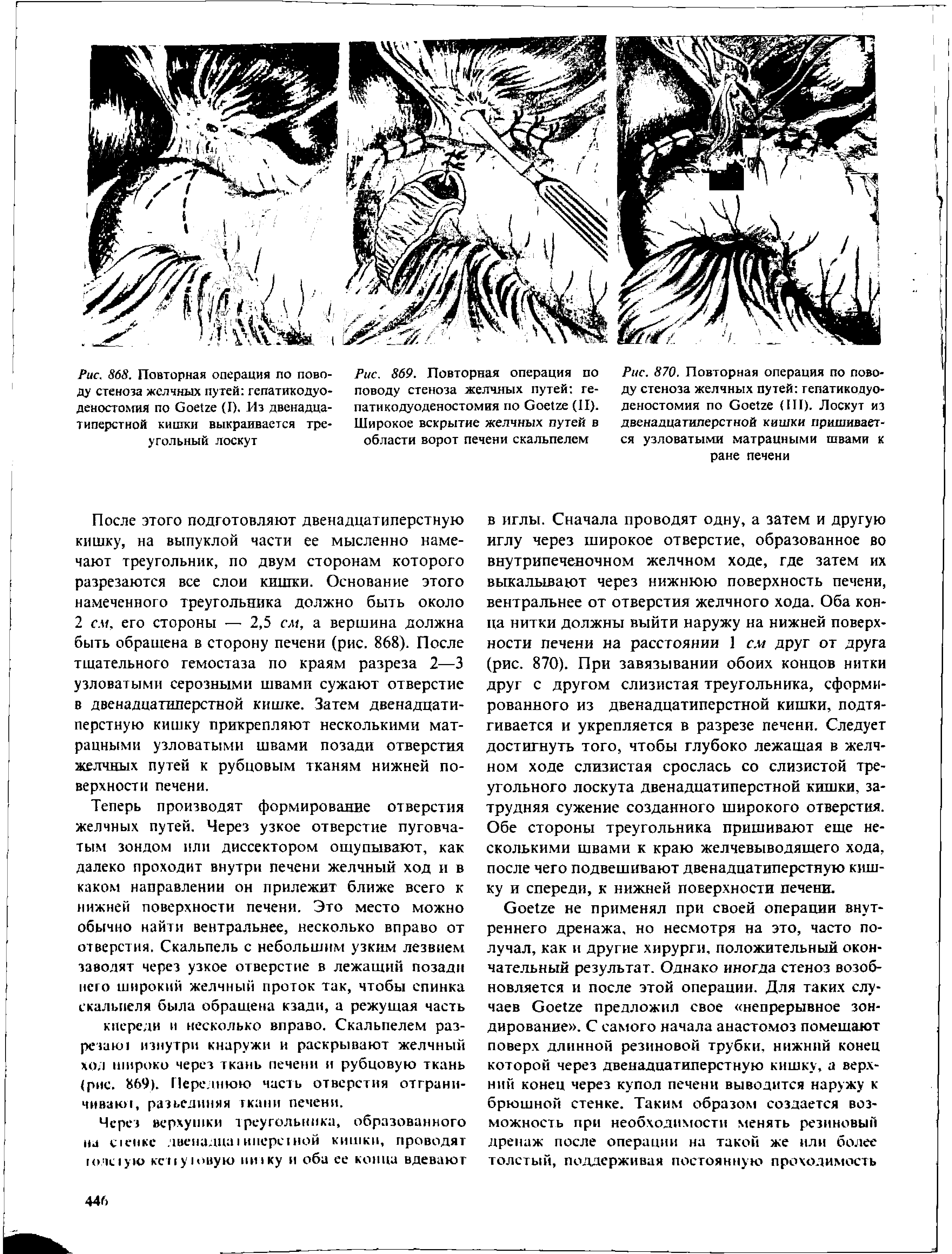 Рис. 870. Повторная операция по поводу стеноза желчных путей гепатикодуо-деностомия по Сое(ге (III). Лоскут из двенадцатиперстной кишки пришивается узловатыми матрацными швами к ране печени...