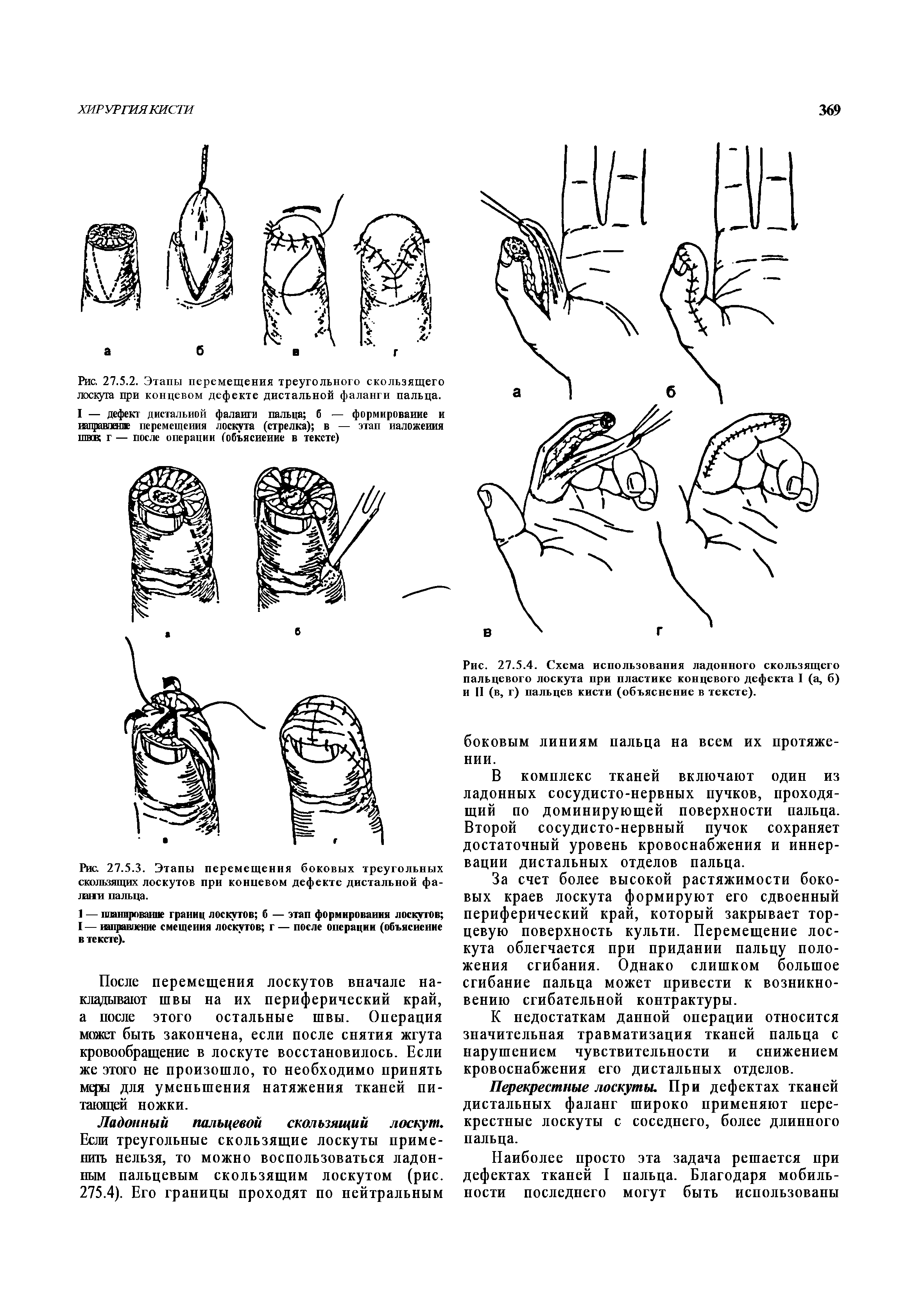 Рис. 27.5.4. Схема использования ладонного скользящего пальцевого лоскута при пластике концевого дефекта I (а, б) и II (в, г) пальцев кисти (объяснение в тексте).