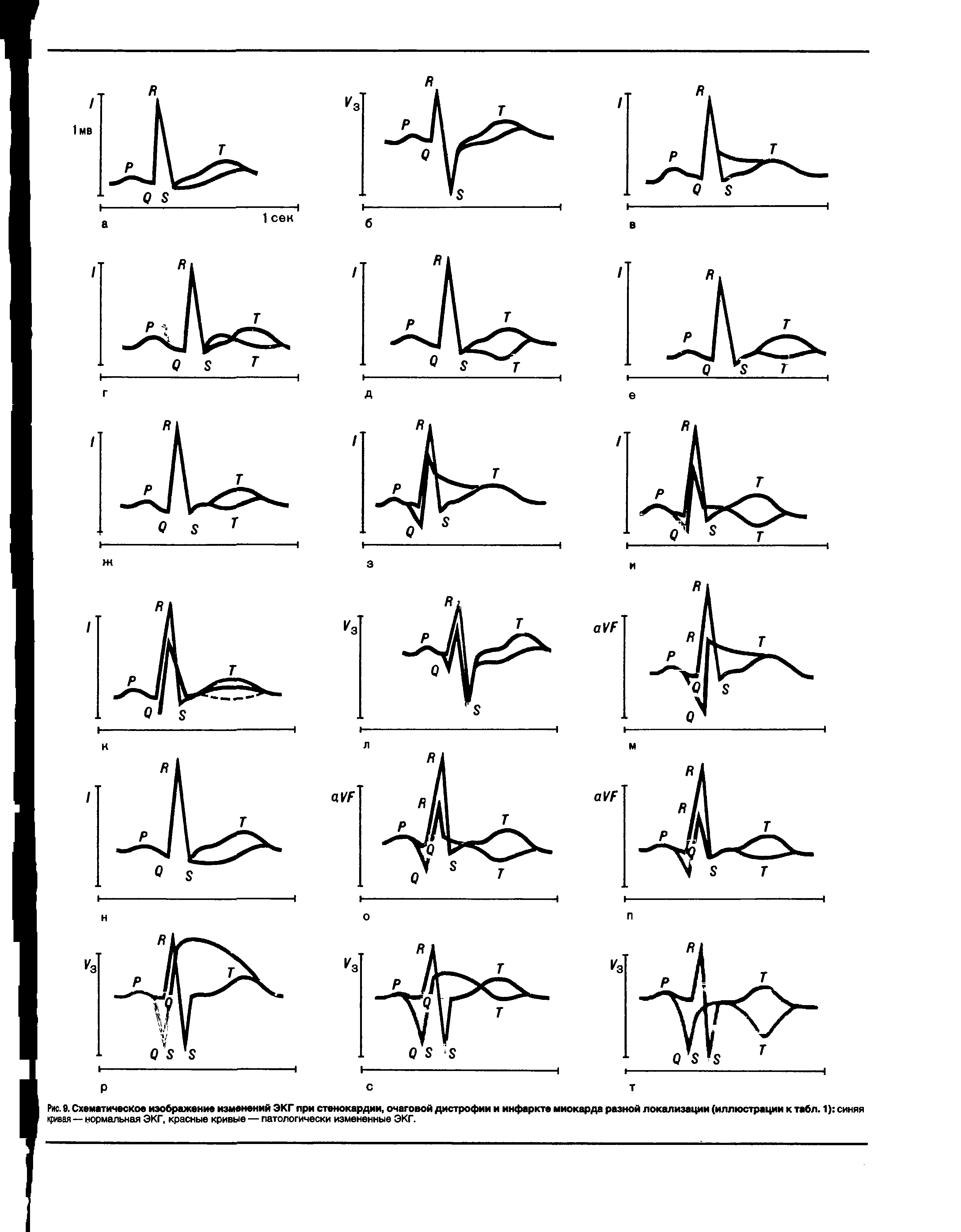 Рис. 9. Схематическое изображение изменений ЭКГ при стенокардии, очаговой дистрофии и инфаркте миокарда разной локализации (иллюстрации к табл. 1) синяя кривая — нормальная ЭКГ, красные кривые — патологически измененные ЭКГ.