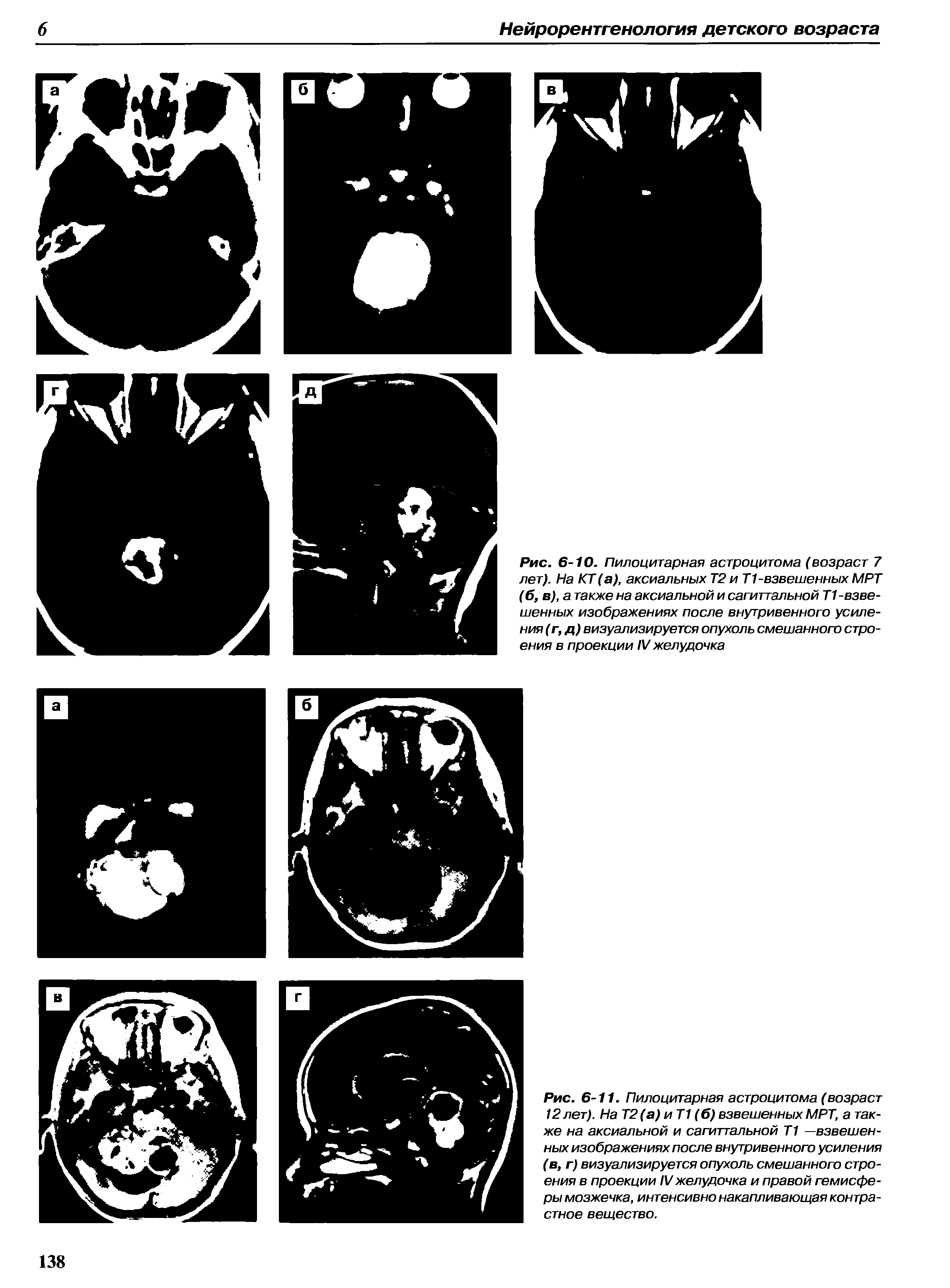 Рис. 6-11. Пилоцитарная астроцитома (возраст 12лет). На Т2(а) и Т1 (б) взвешенныхМРТ, а также на аксиальной и сагиттальной Т1 —взвешенных изображениях после внутривенного усиления (в, г) визуализируется опухоль смешанного строения в проекции IVжелудочка и правой гемисферы мозжечка, интенсивно накапливающая контрастное вещество.