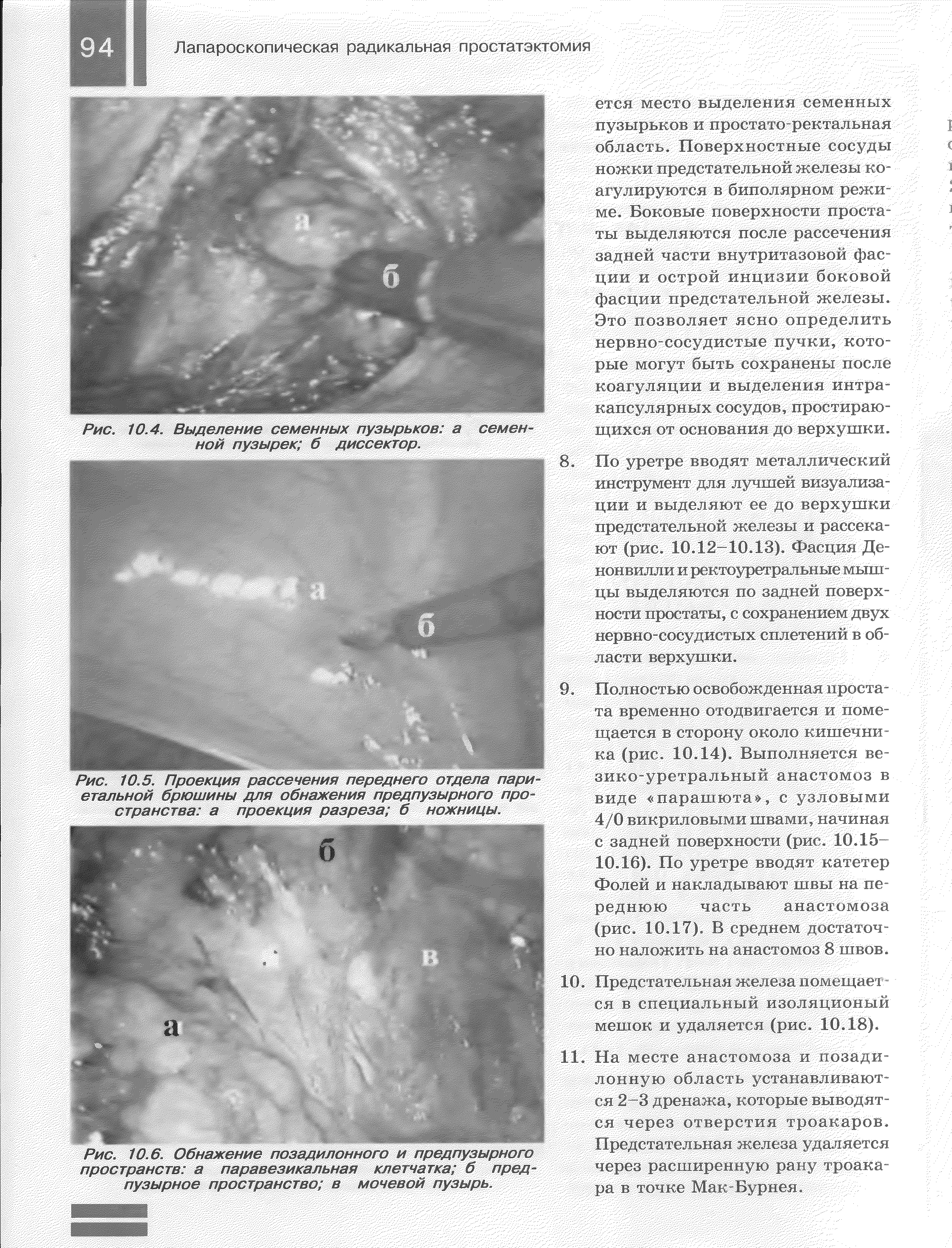 Рис. 10.6. Обнажение позадилонного и предпузырного пространств а паравезикальная клетчатка б пред пузырное пространство в мочевой пузырь.