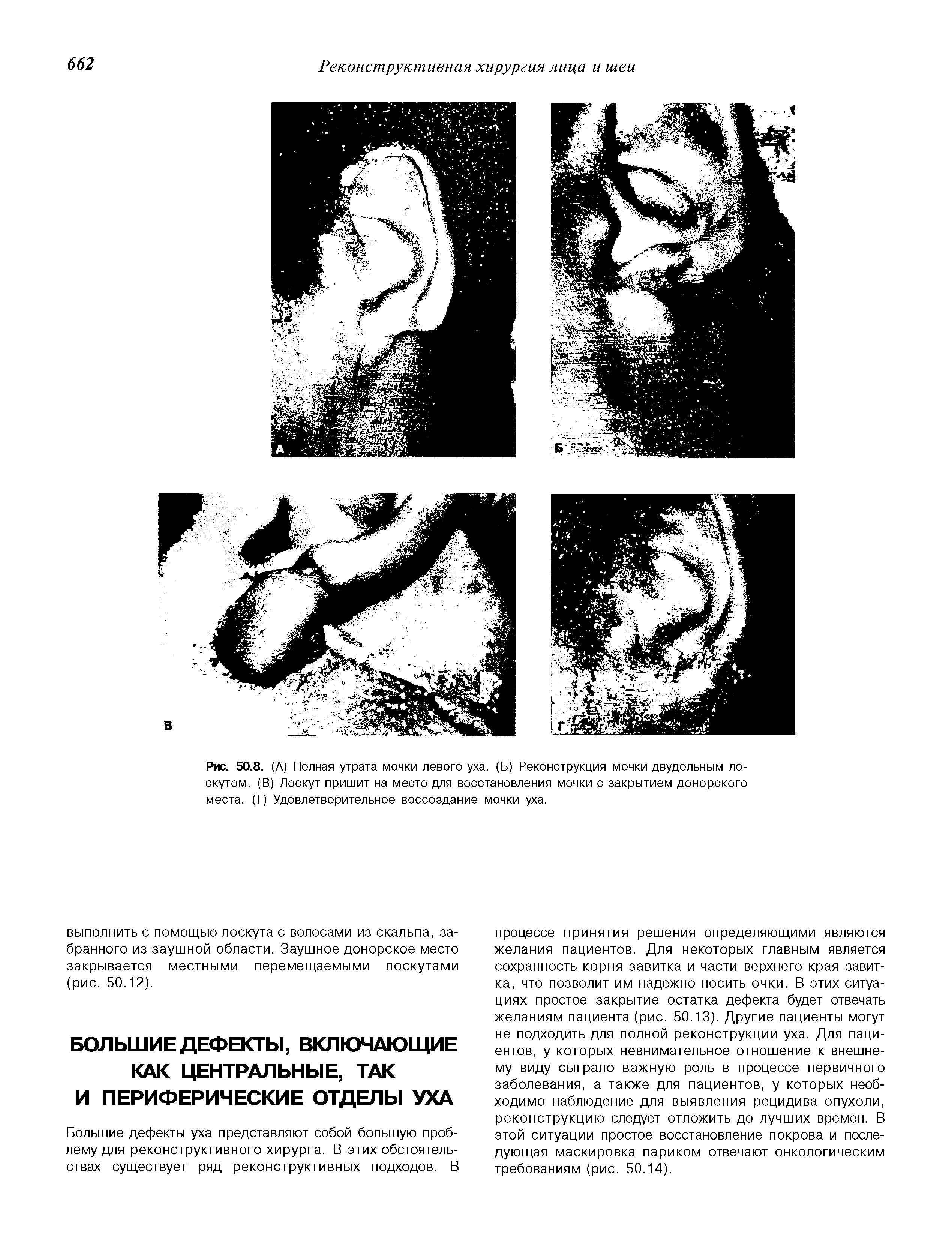 Рис. 50.8. (А) Полная утрата мочки левого уха. (Б) Реконструкция мочки двудольным лоскутом. (В) Лоскут пришит на место для восстановления мочки с закрытием донорского места. (Г) Удовлетворительное воссоздание мочки уха.