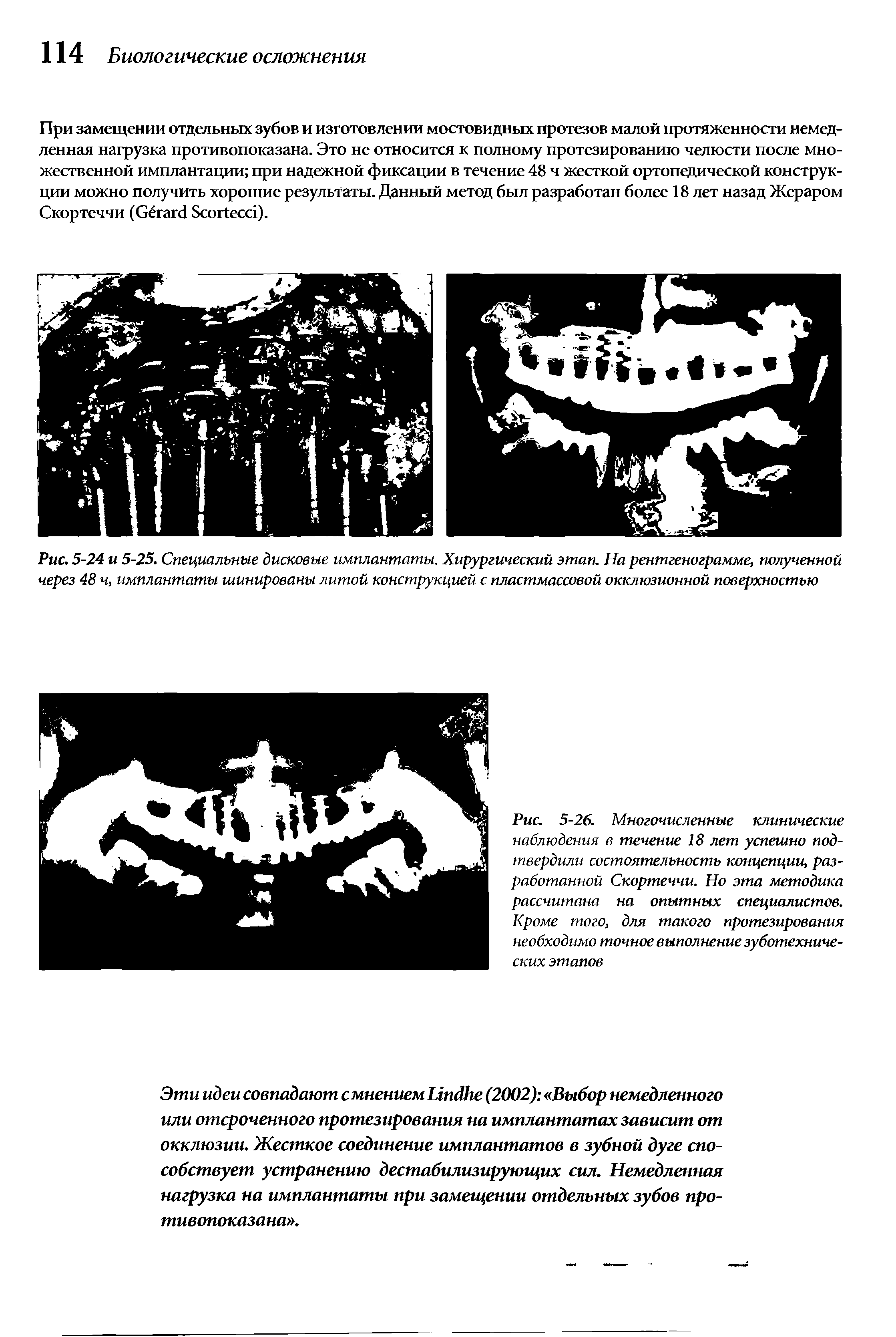 Рис. 5-26. Многочисленные клинические наблюдения в течение 18 лет успешно подтвердили состоятельность концепции, разработанной Скортеччи. Но эта методика рассчитана на опытных специалистов. Кроме того, для такого протезирования необходимо точное выполнение зуботехнических этапов...