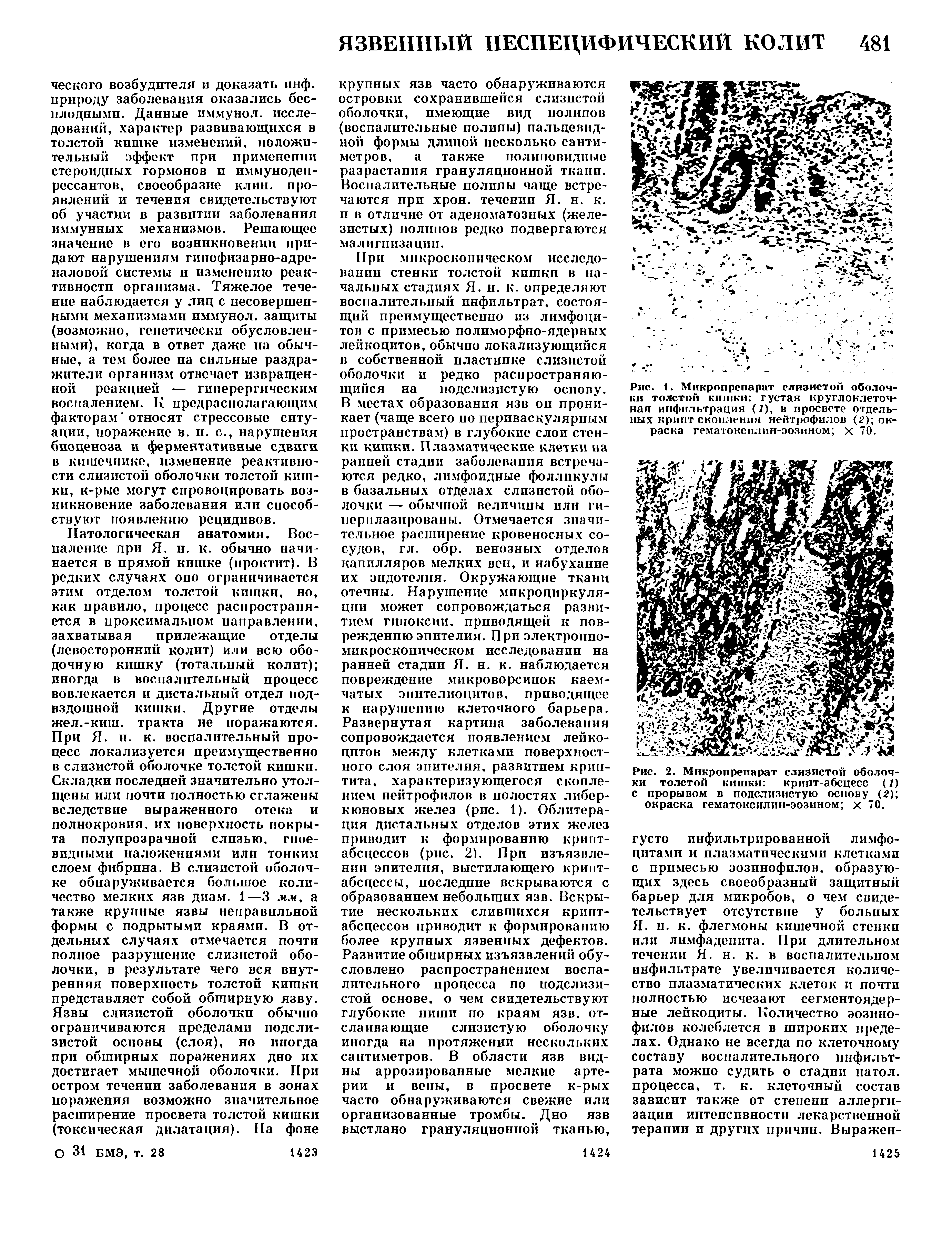 Рис. 1. Микропрепарат слизистой оболочки толстой кишки густая круглоклеточная инфильтрация (I), в просвете отдельных крипт скопления нейтрофилов (2) окраска гематоксилин-эозином х 70.