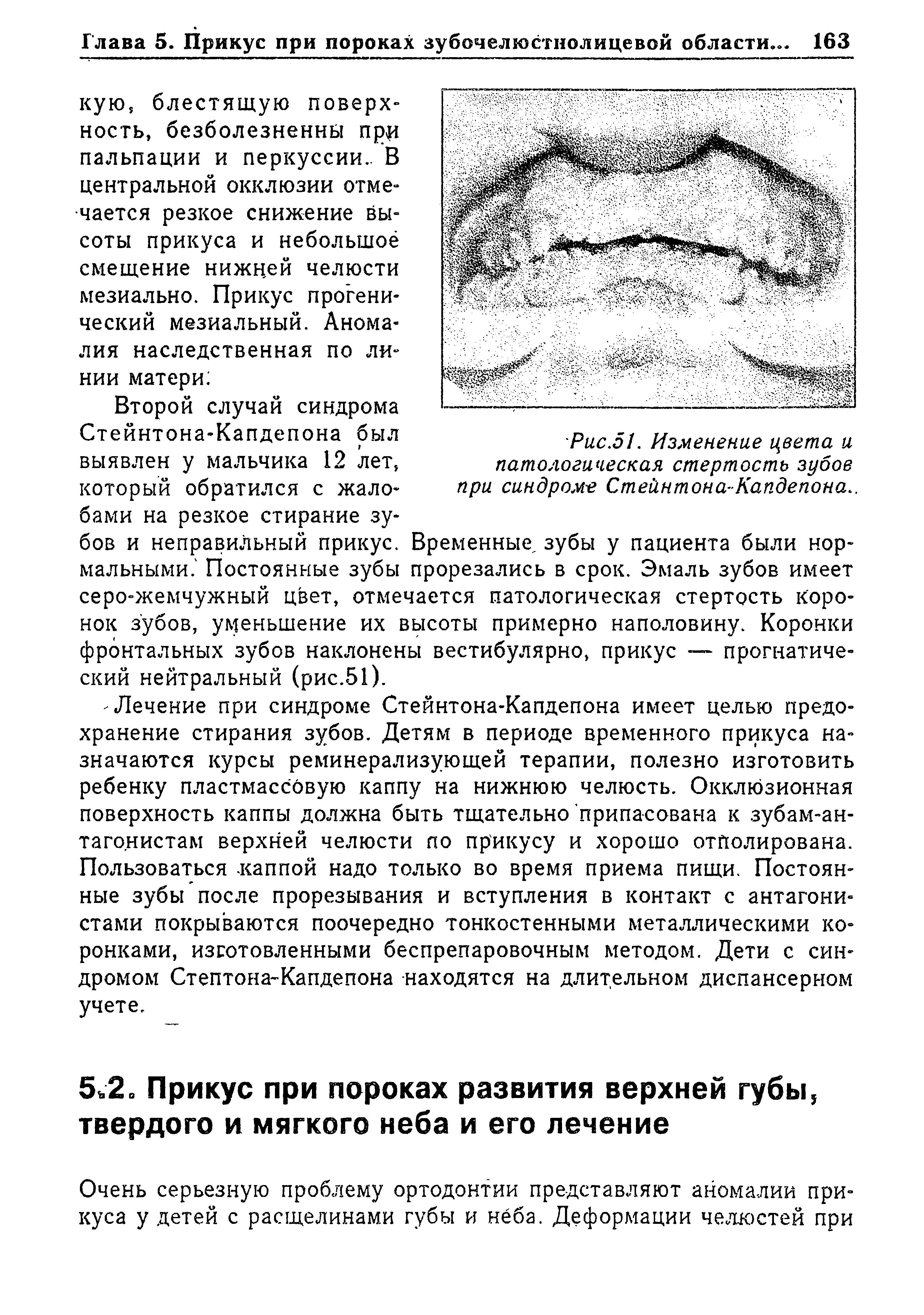 Рис.51. Изменение цвета и патологическая стертость зубов при синдроме Стейнтона-Капдепона..