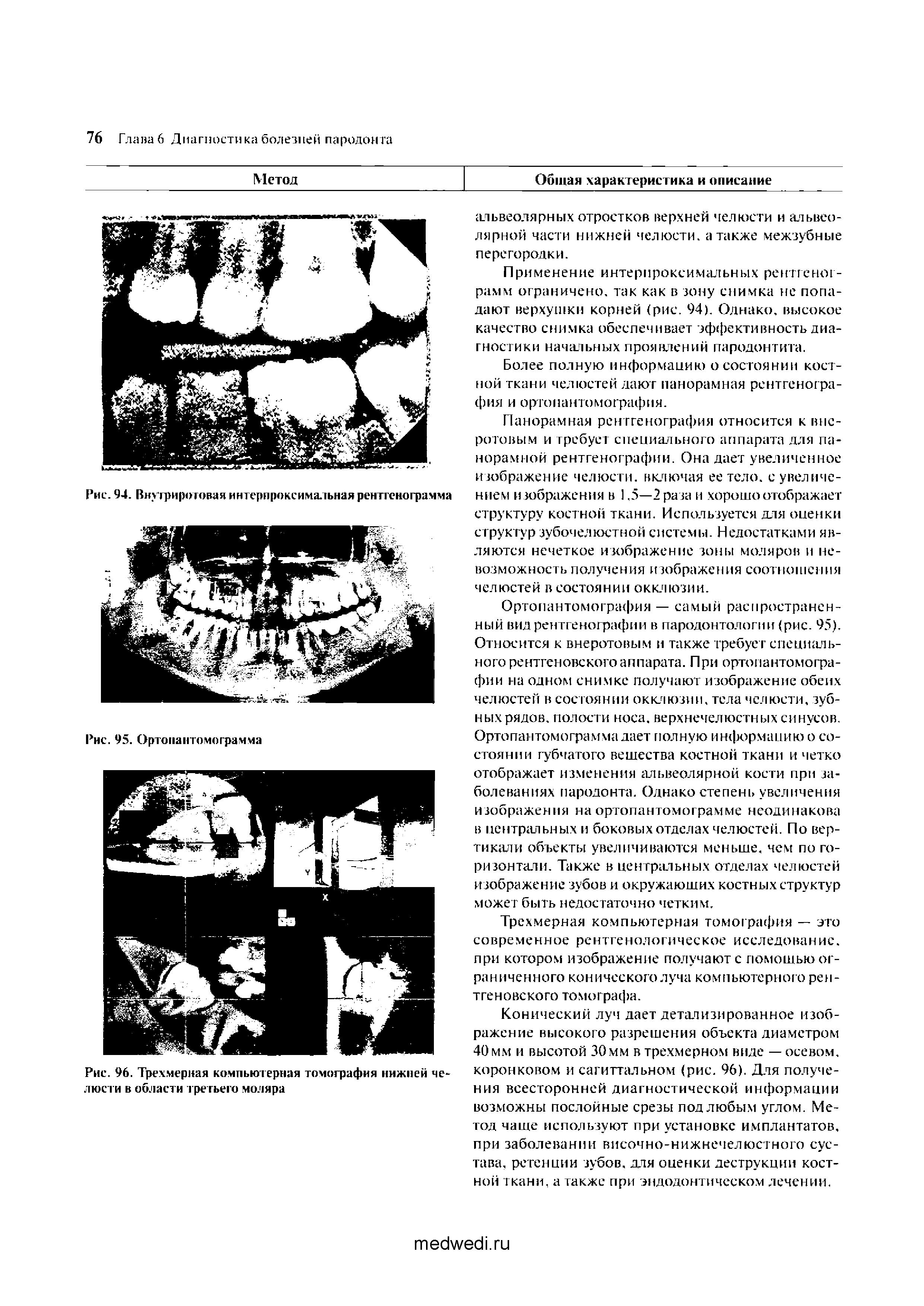 Рис. 96. Трехмерная компьютерная томография нижней челюсти в области гре тьего моляра...