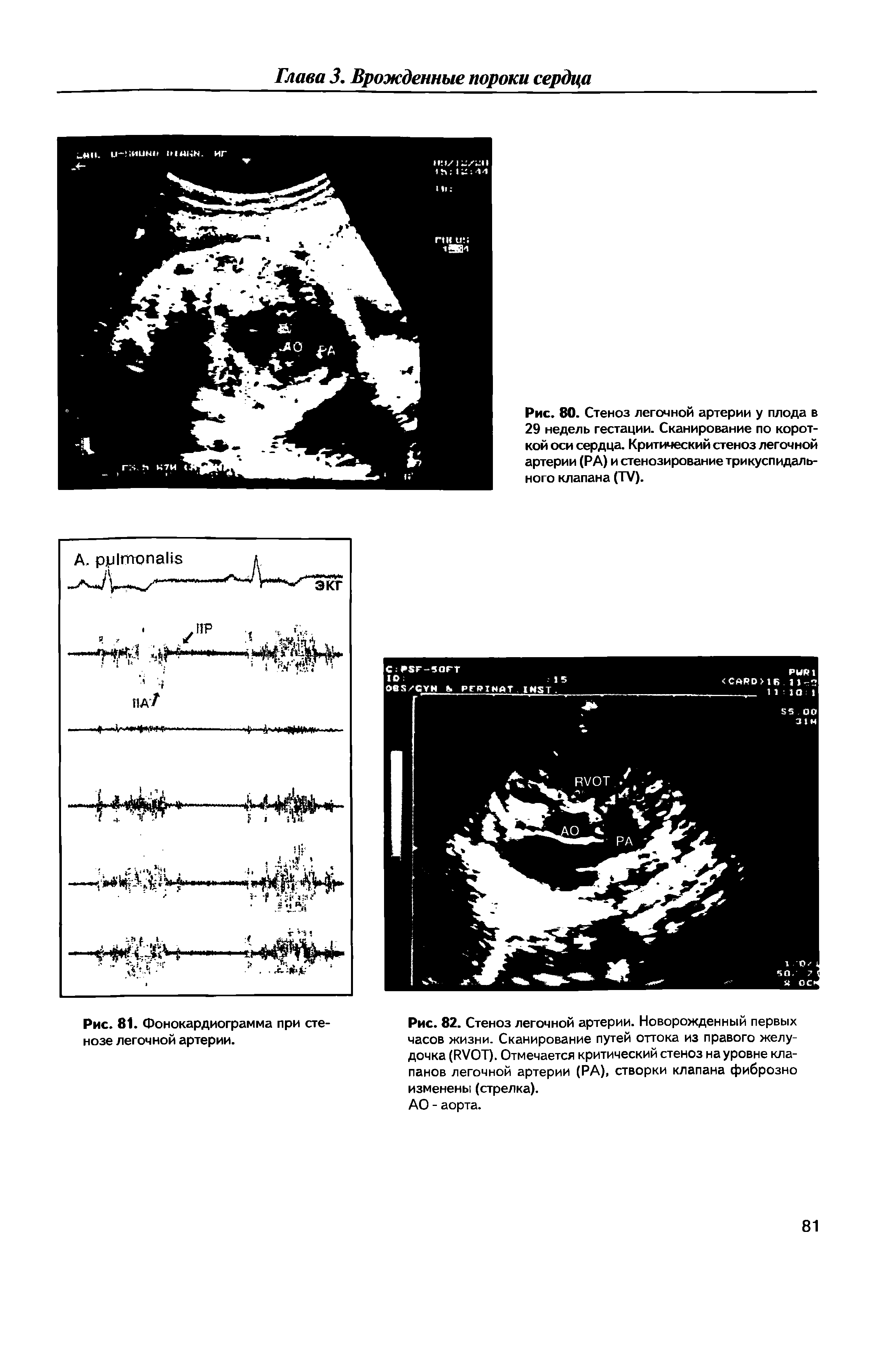 Рис. 81. Фонокардиограмма при стенозе легочной артерии. Рис. 82. Стеноз легочной артерии. Новорожденный первых часов жизни. Сканирование путей оттока из правого желудочка (РУОТ). Отмечается критический стеноз на уровне клапанов легочной артерии (РА), створки клапана фиброзно изменены (стрелка). АО - аорта.