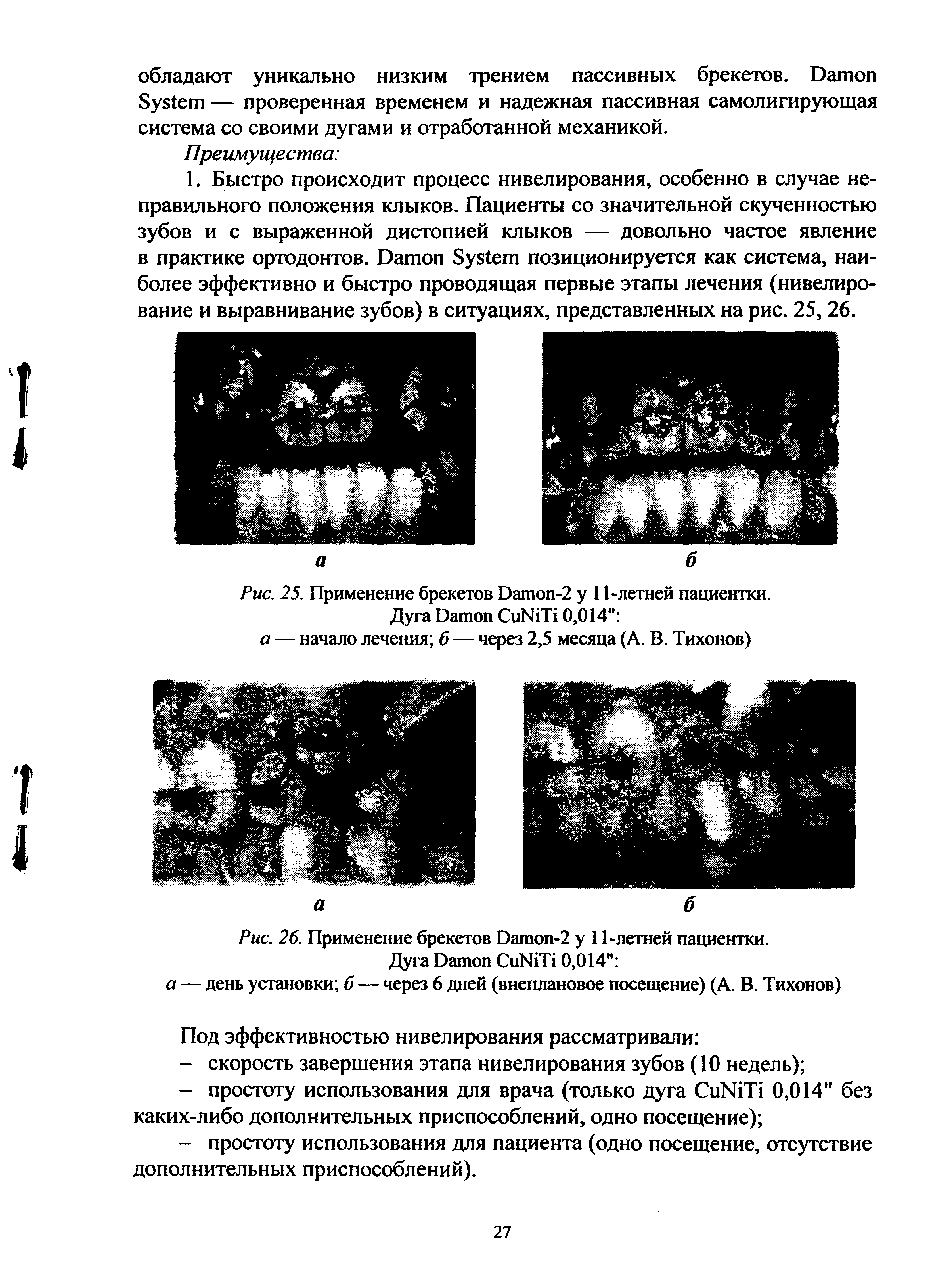 Рис. 26. Применение брекетов D -2 у 1 -летней пациентки. Дуга D C N T 0,014 а — день установки б — через 6 дней (внеплановое посещение) (А. В. Тихонов)...