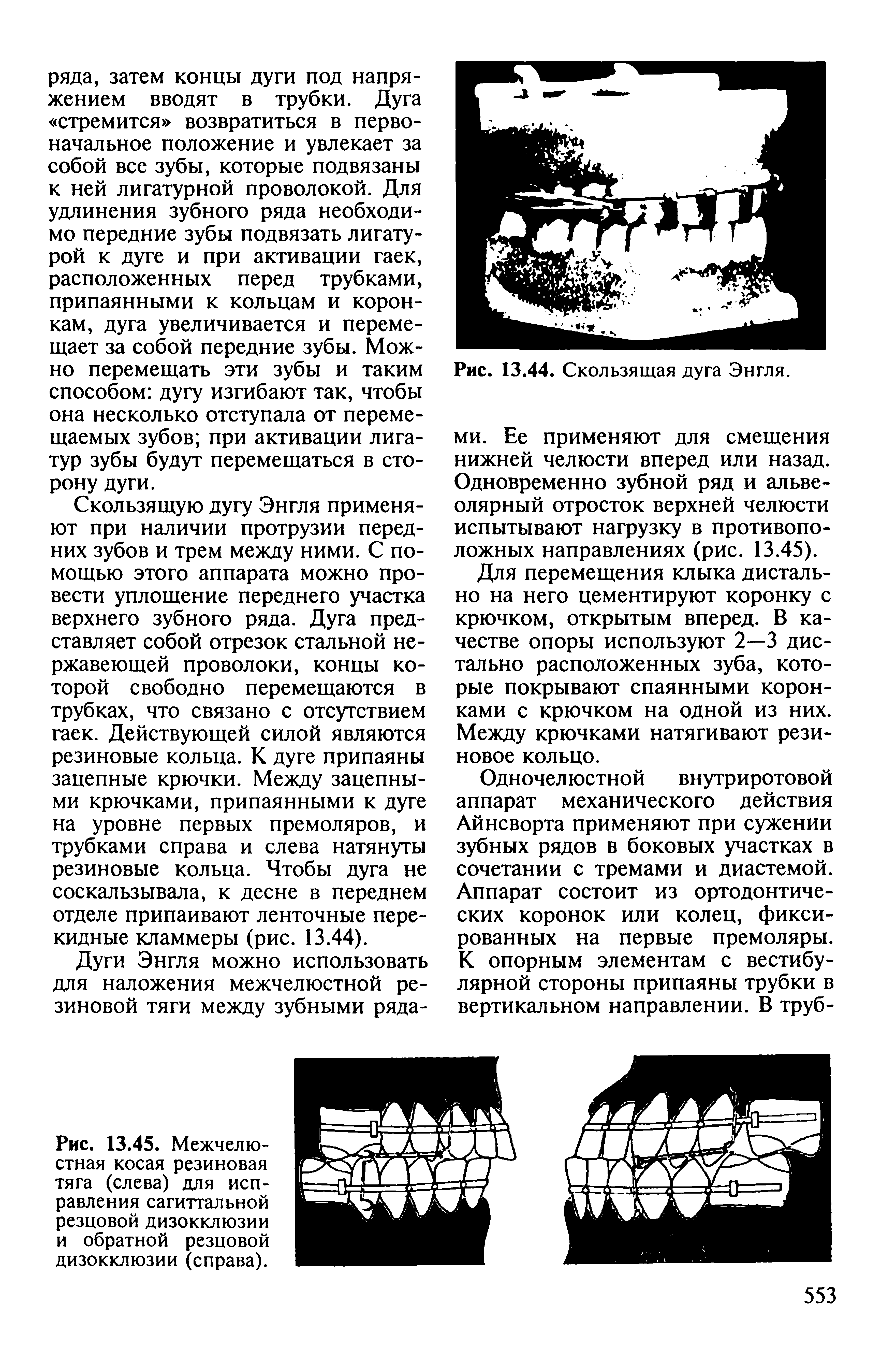 Рис. 13.45. Межчелюстная косая резиновая тяга (слева) для исправления сагиттальной резцовой дизокклюзии и обратной резцовой дизокклюзии (справа).