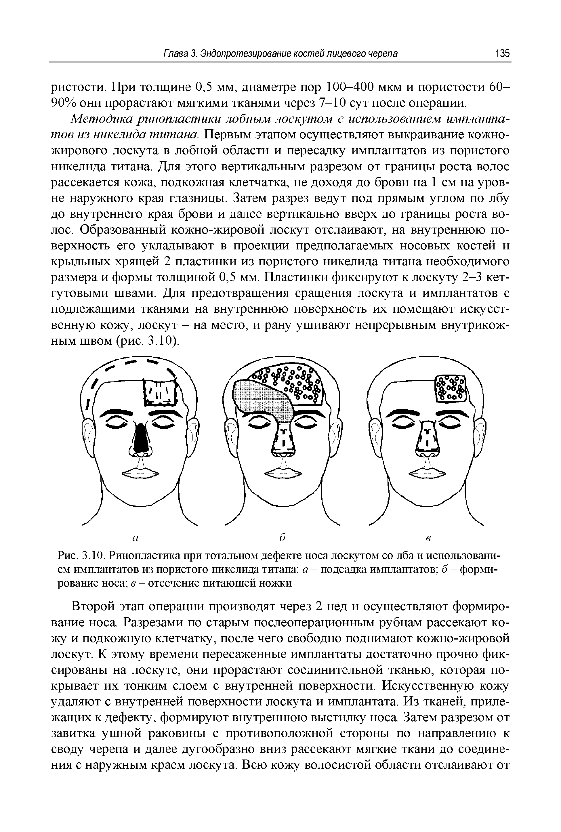 Рис. 3.10. Ринопластика при тотальном дефекте носа лоскутом со лба и использованием имплантатов из пористого никелида титана а - подсадка имплантатов б - формирование носа в - отсечение питающей ножки...