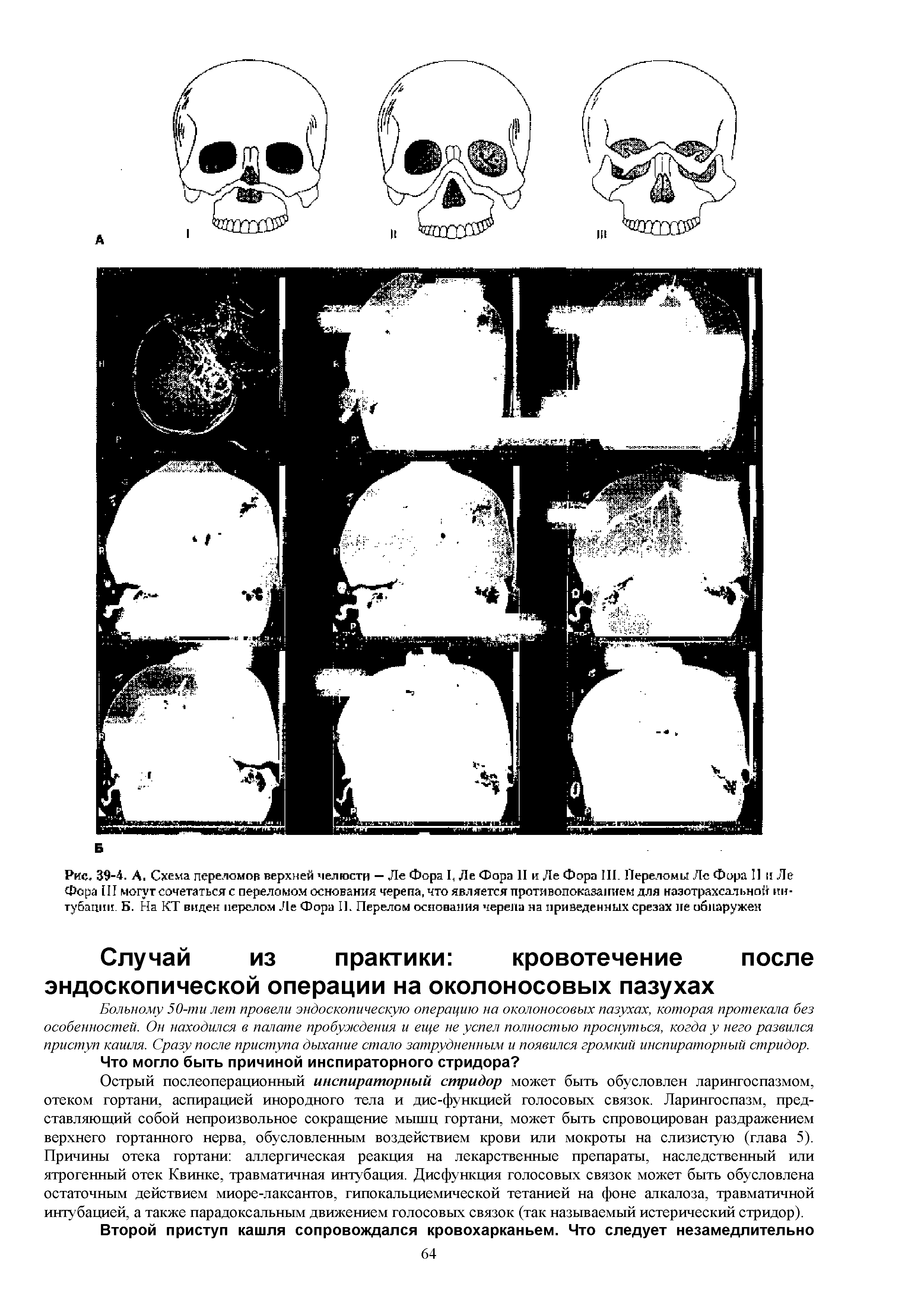 Рис. 39-4. А. Схема переломов верхней челюсти — Ле Фора I, Ле Фора II и Ле Фора III. Переломи Ле Фора II и Ле Фора III могут сочетаться с переломом основания черепа, что является противопоказанием для назотрахеальной интубации. Б. На КТ виден перелом Ле Фора II. Перелом основания черепа на приведенных срезах не обнаружен...
