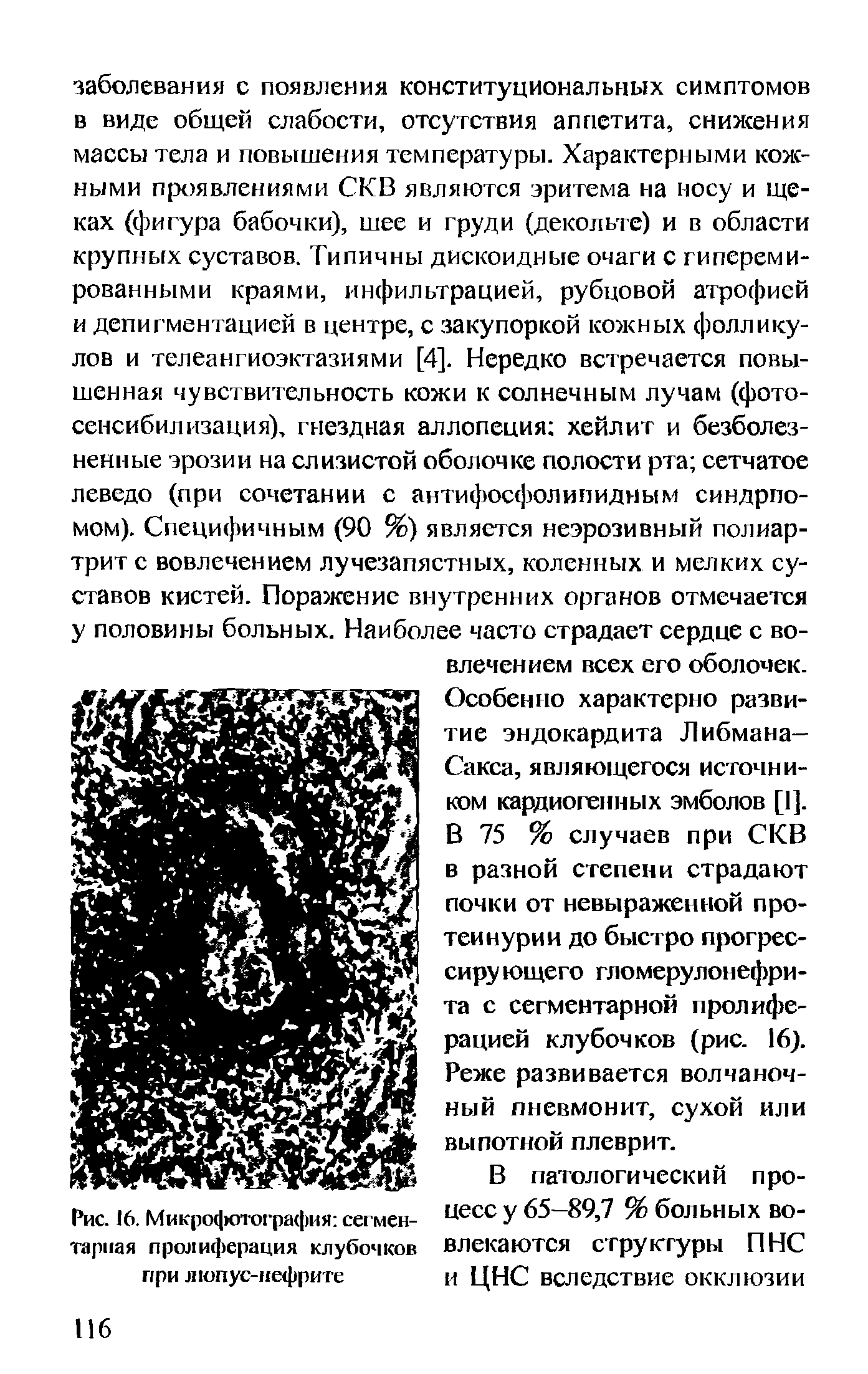 Рис. 16. Микрофотография сегментарная пролиферация клубочков при люпус-нефрите...