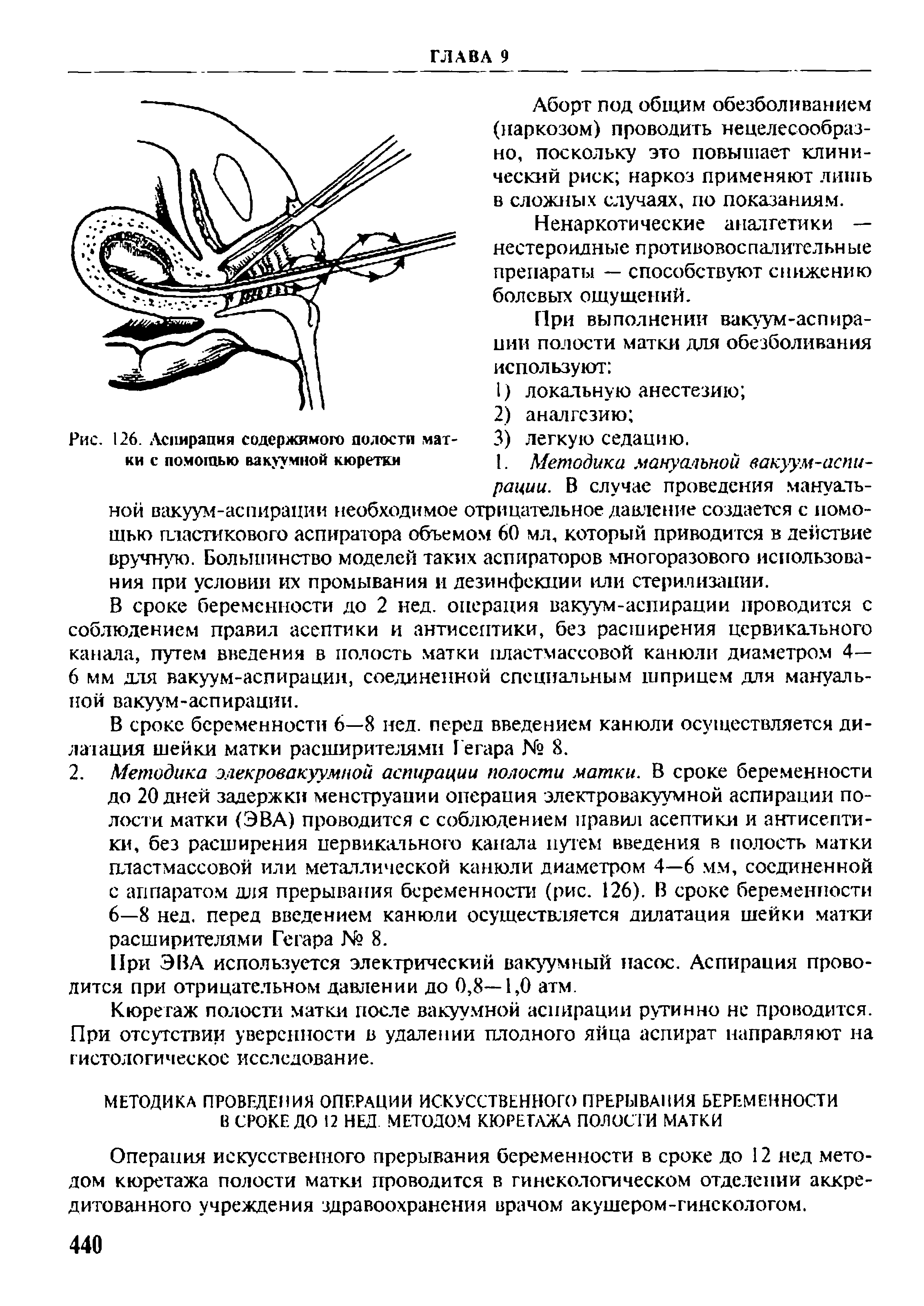 Рис. 126. Аспирация содержимого полости матки с помощью вакуумной кюретки...