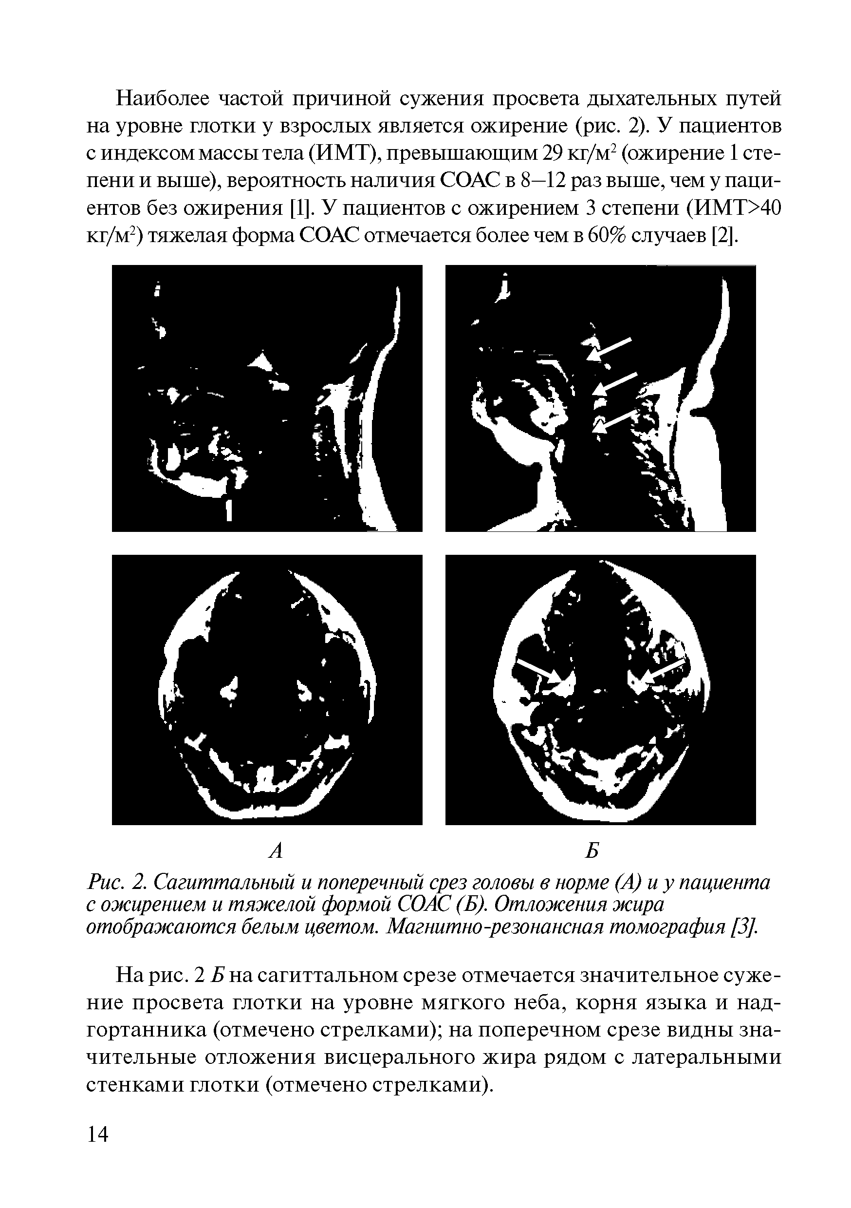 Рис. 2. Сагиттальный и поперечный срез головы в норме (А) и у пациента с ожирением и тяжелой формой СОАС (Б). Отложения жира отображаются белым цветом. Магнитно-резонансная томография [3].