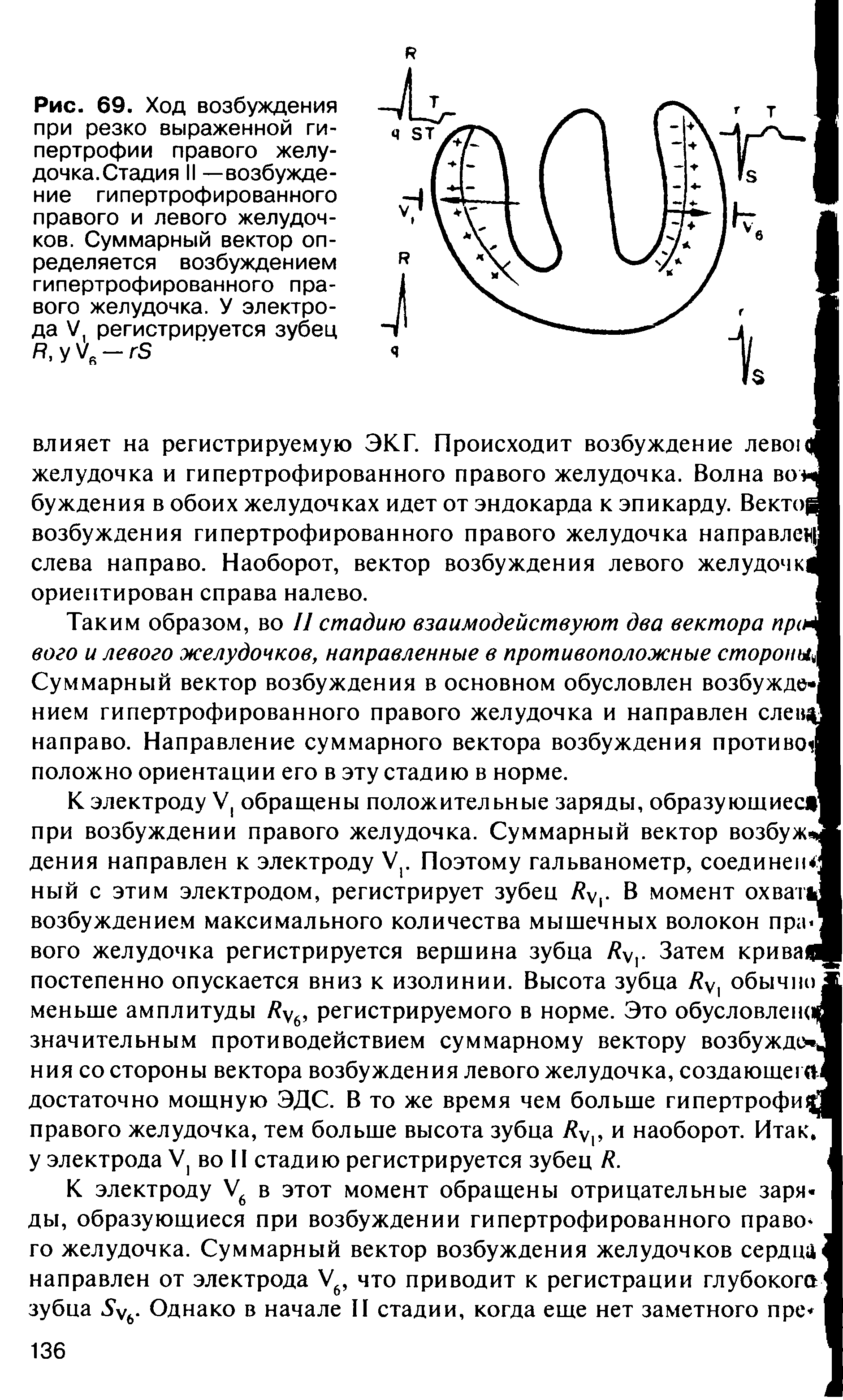 Рис. 69. Ход возбуждения при резко выраженной гипертрофии правого желудочка. Стадия II —возбуждение гипертрофированного правого и левого желудочков. Суммарный вектор определяется возбуждением гипертрофированного правого желудочка. У электрода V регистрируется зубец . V.- S...