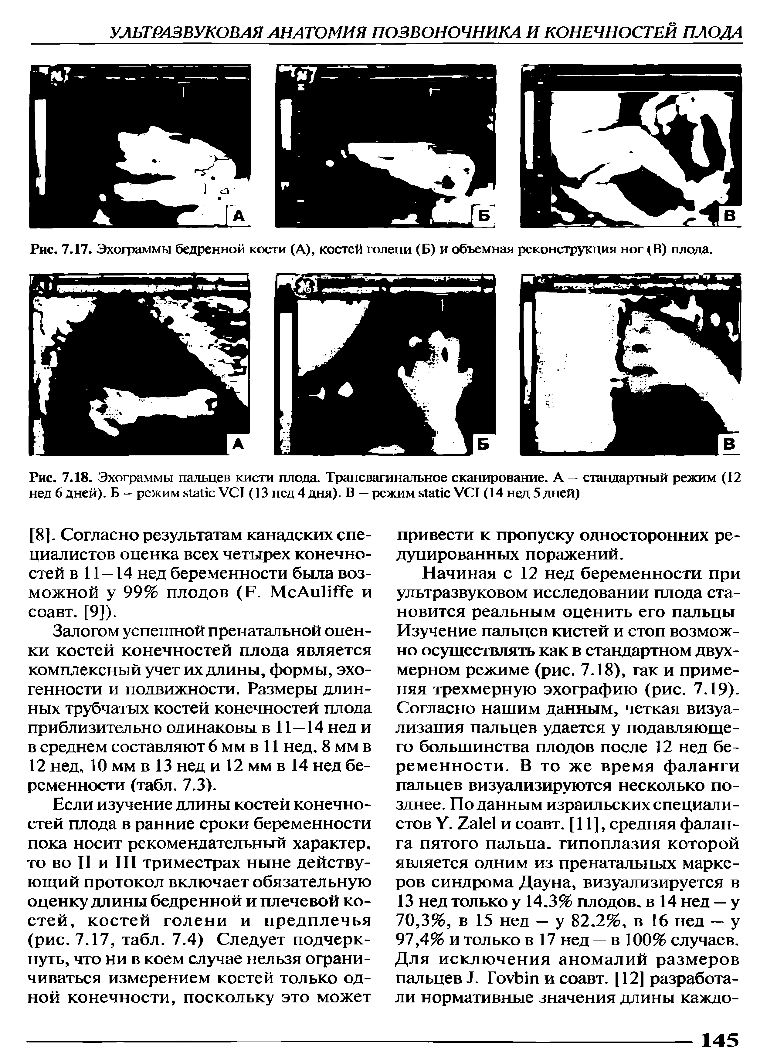 Рис. 7.18. Эхограммы пальцев кисти плода. Трансвагинальное сканирование. А — стандартный режим (12 нед 6 дней). Б — режим VCI (13 нед 4 дня). В — режим VCI (14 нед 5 дней)...