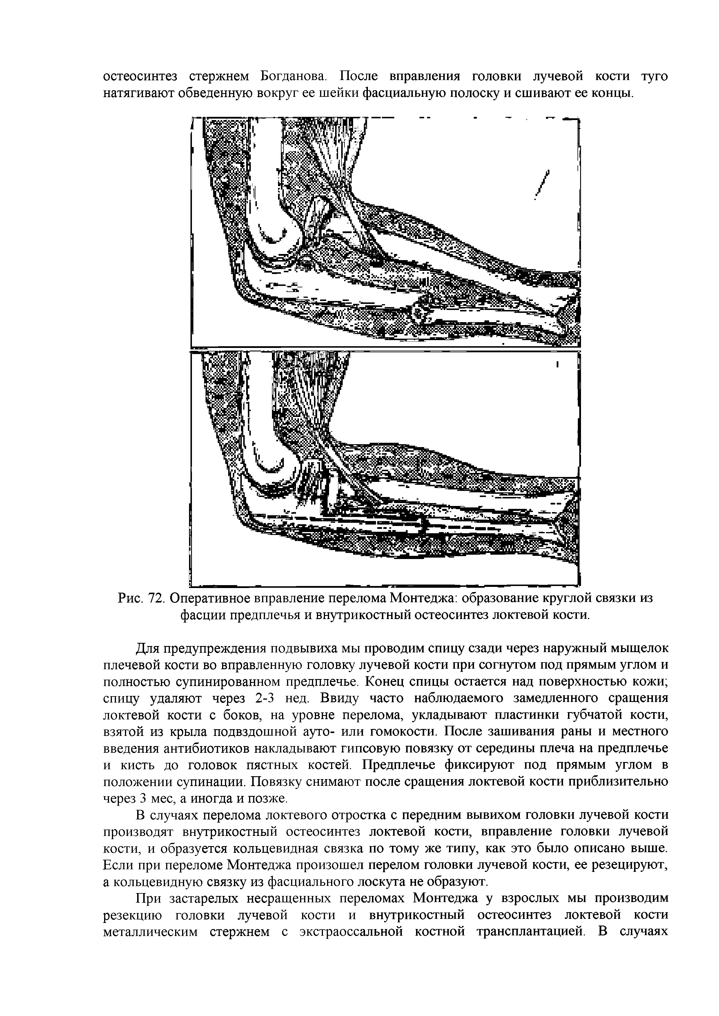 Рис. 72. Оперативное вправление перелома Монтеджа образование круглой связки из фасции предплечья и внутрикостный остеосинтез локтевой кости.