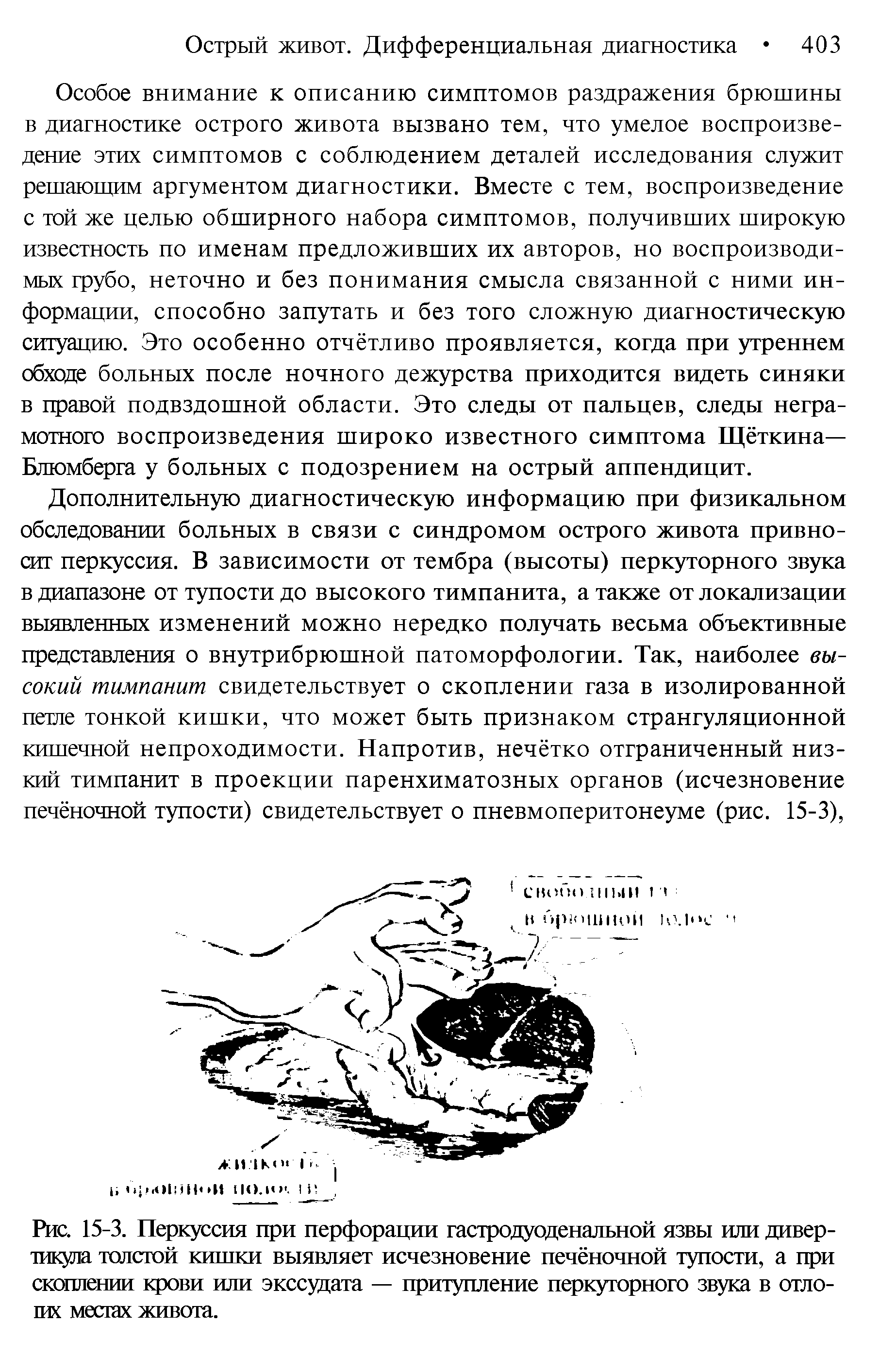 Рис. 15-3. Перкуссия при перфорации гастродуоденальной язвы или дивертикула толстой кишки выявляет исчезновение печёночной тупости, а при скоплении крови или экссудата — притупление перкуторного звука в отло-шх местах живота.