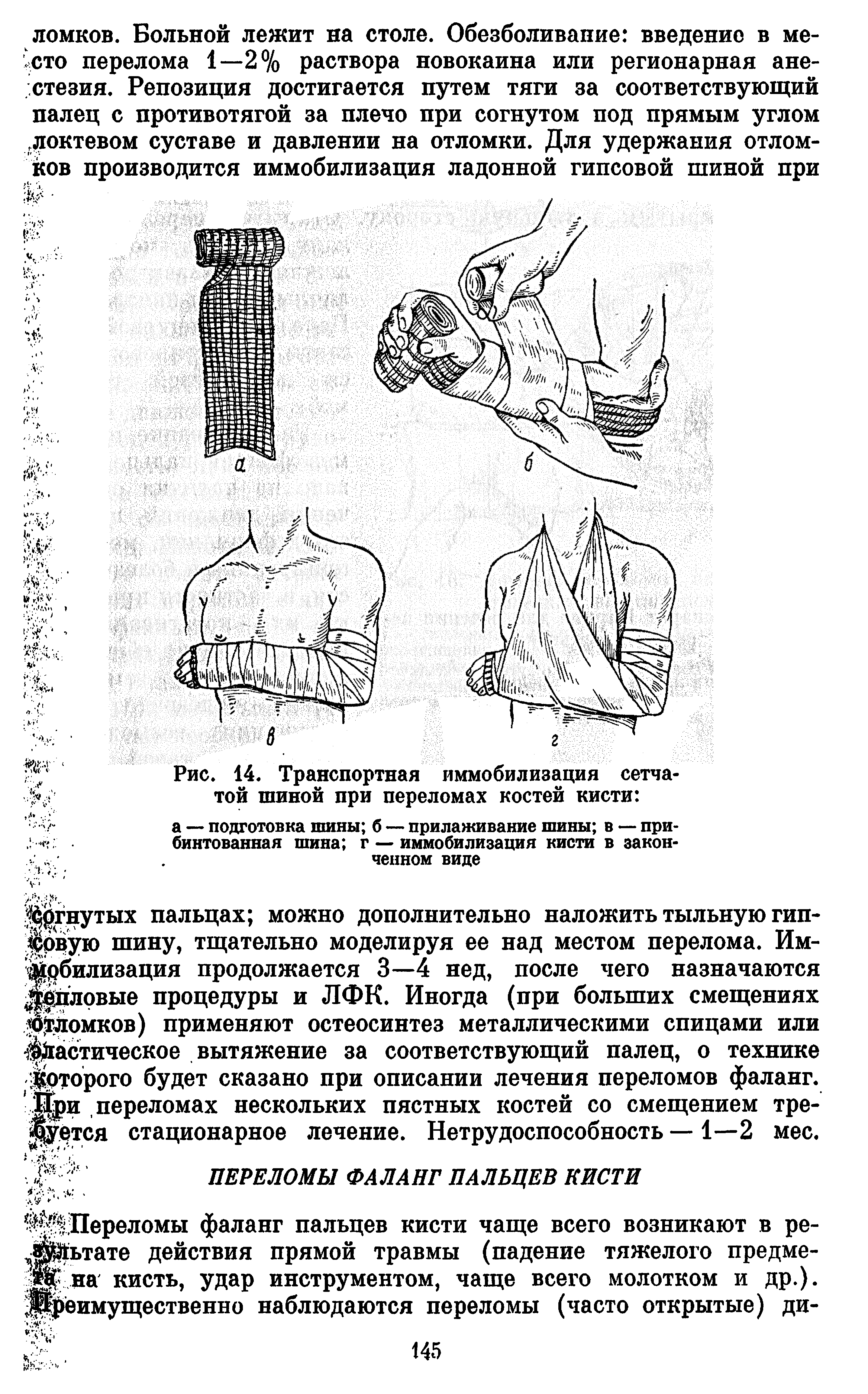 Рис. 14. Транспортная иммобилизация сетчатой шиной при переломах костей кисти ...