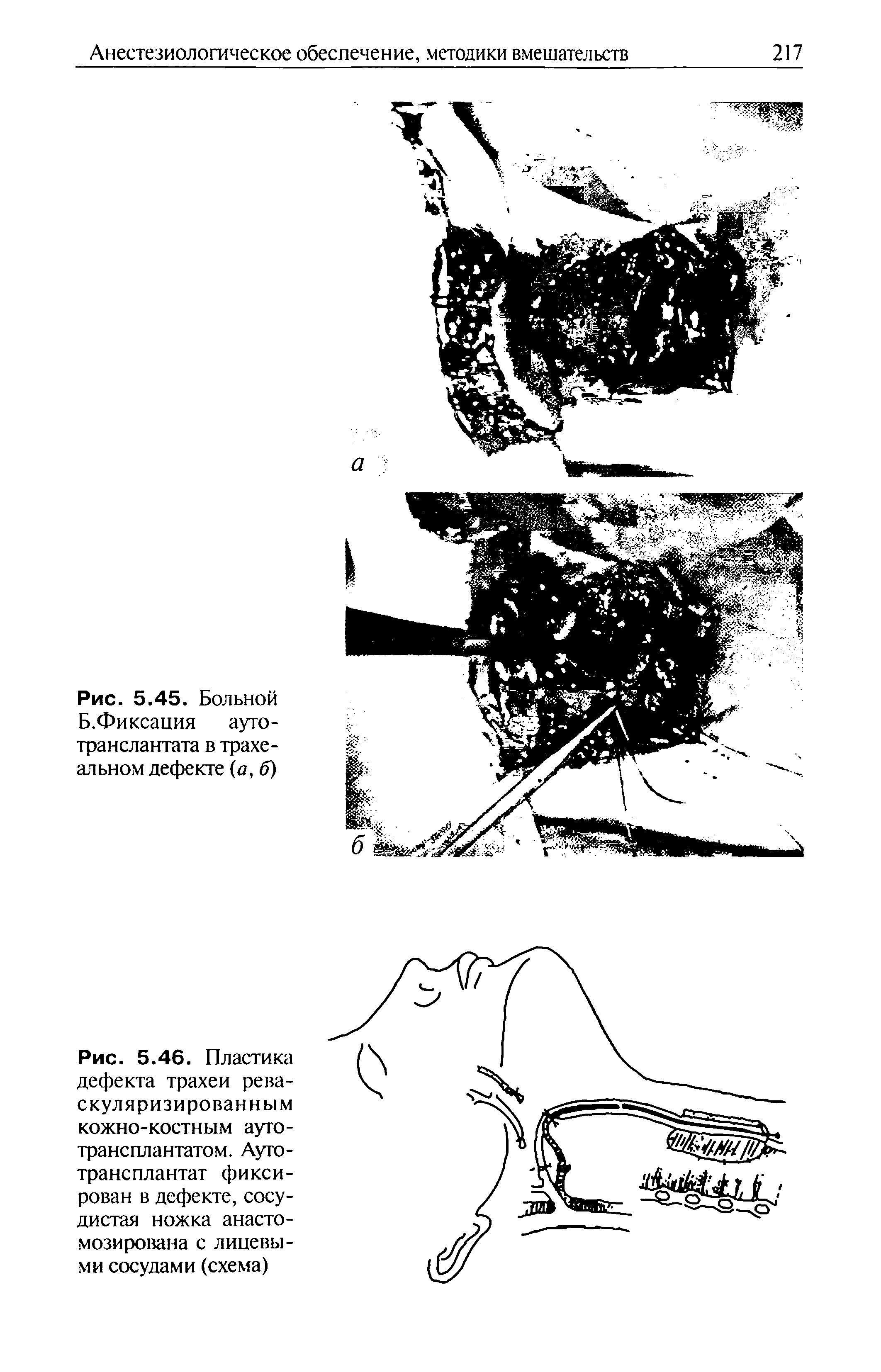 Рис. 5.46. Пластика дефекта трахеи рева-скуляризированным кожно-костным аутотрансплантатом. Аутотрансплантат фиксирован в дефекте, сосудистая ножка анастомозирована с лицевыми сосудами (схема)...