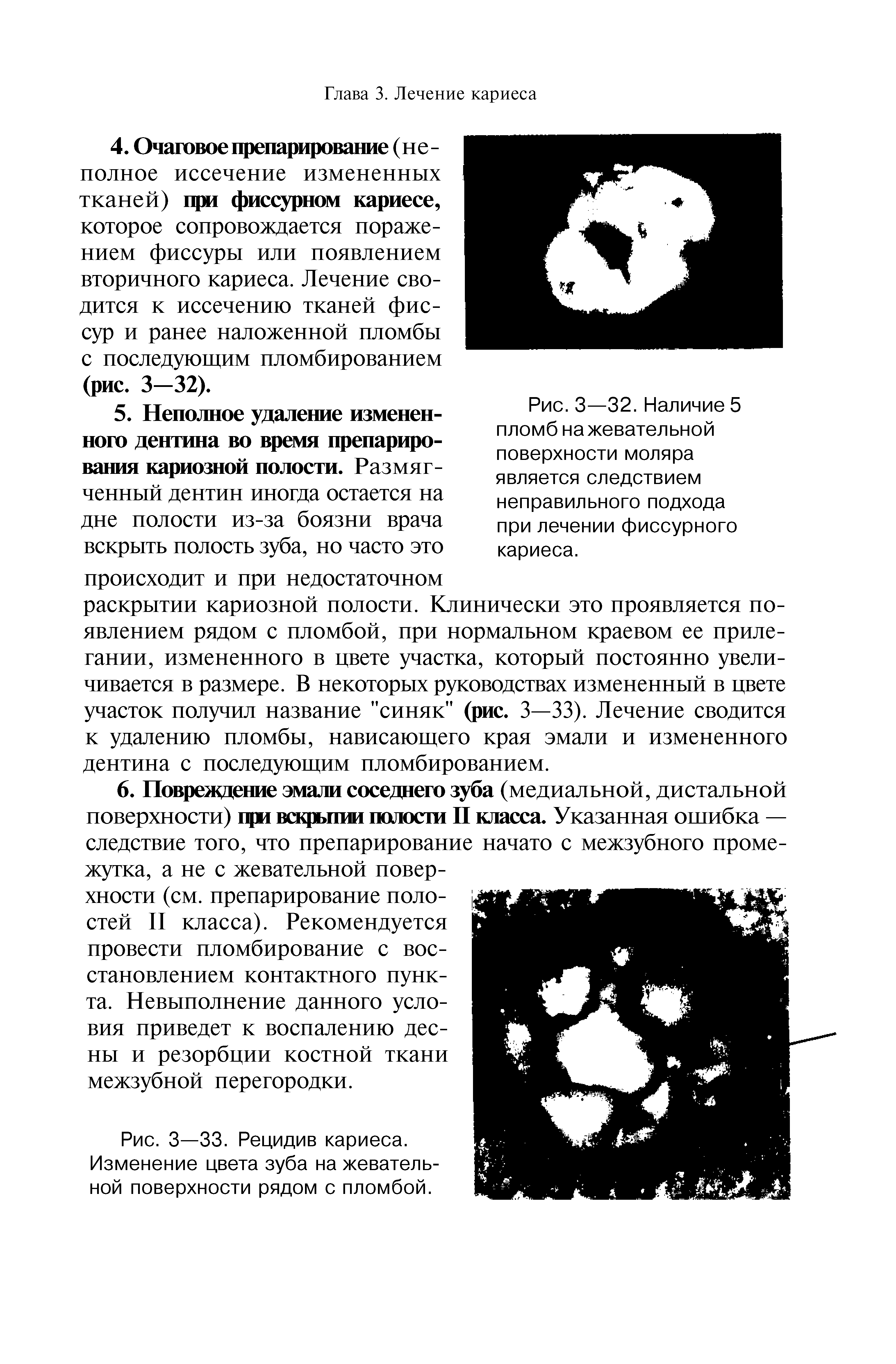 Рис. 3—33. Рецидив кариеса. Изменение цвета зуба на жевательной поверхности рядом с пломбой.