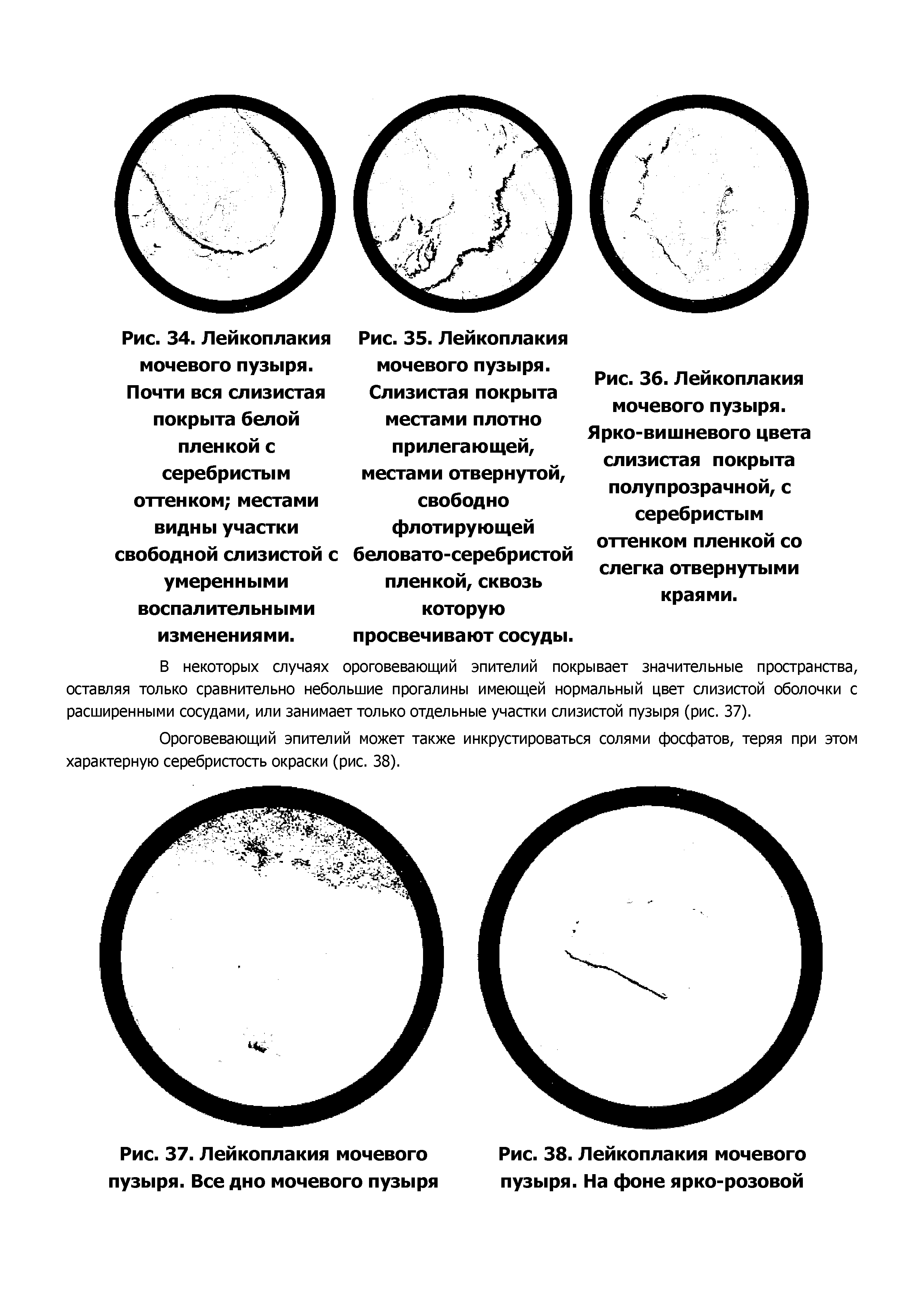 Рис. 38. Лейкоплакия мочевого пузыря. На фоне ярко-розовой...